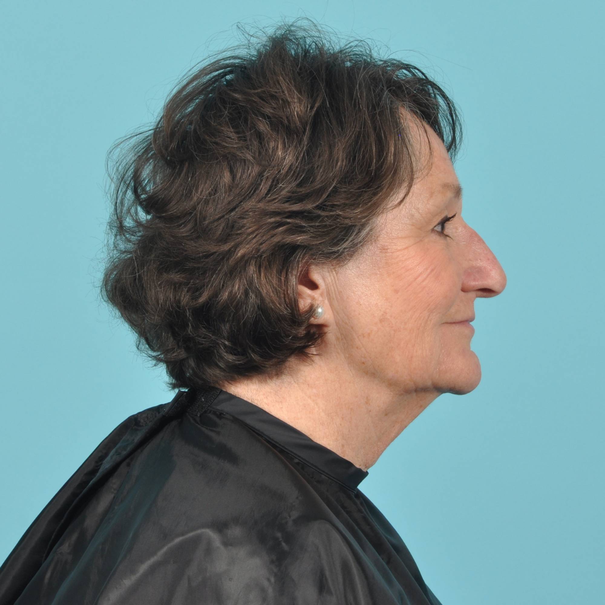 Blepharoplasty Before & After Image