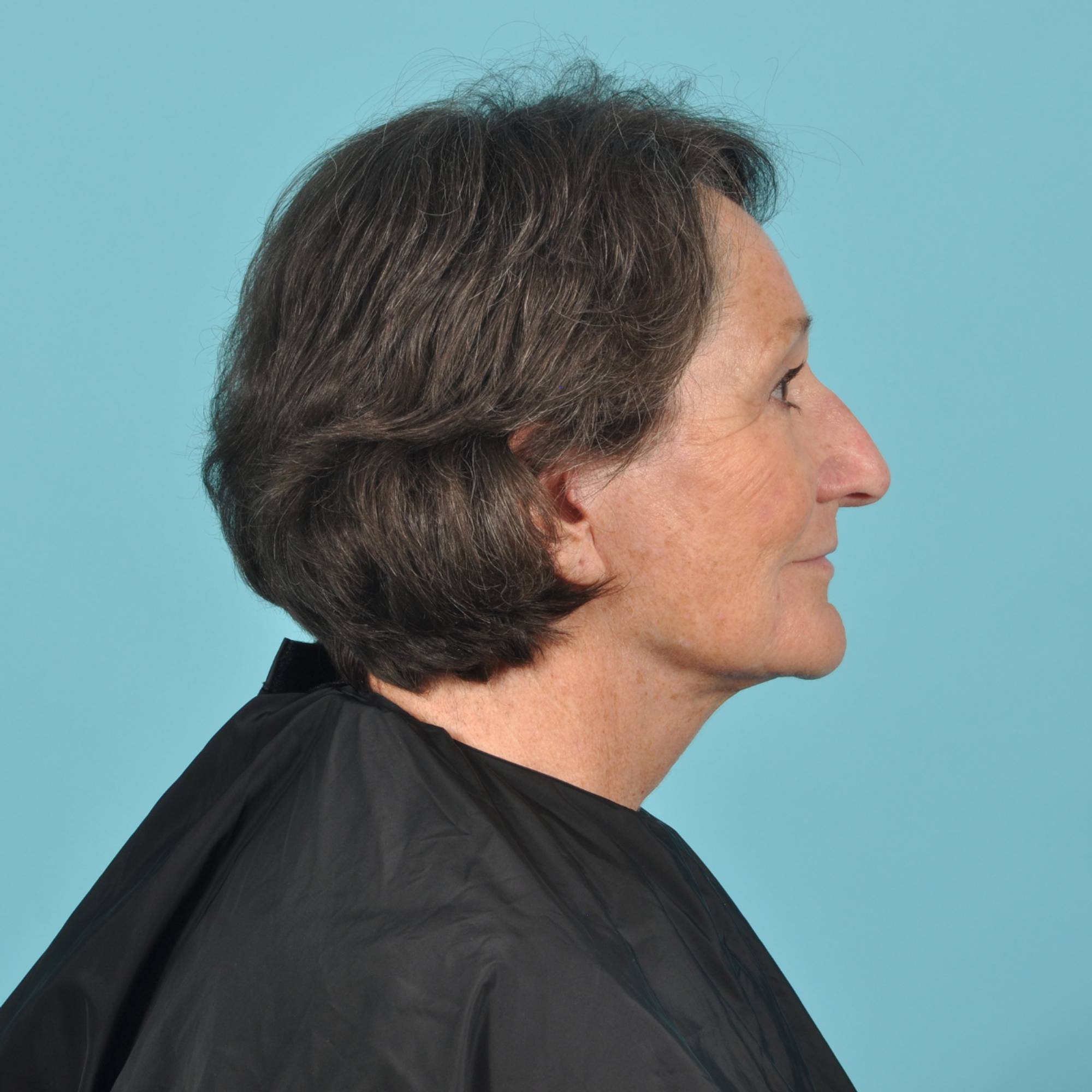 Blepharoplasty Before & After Image