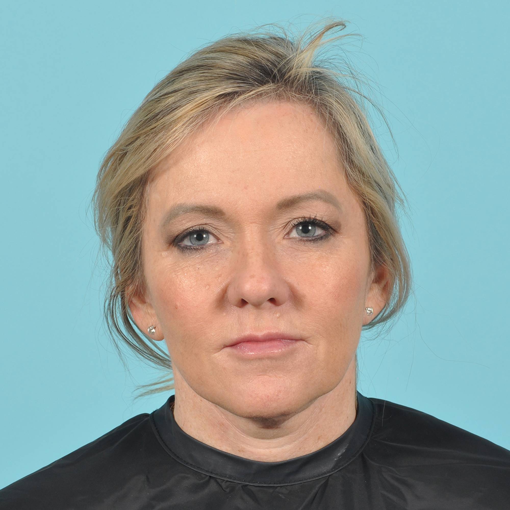 Blepharoplasty Before & After Image