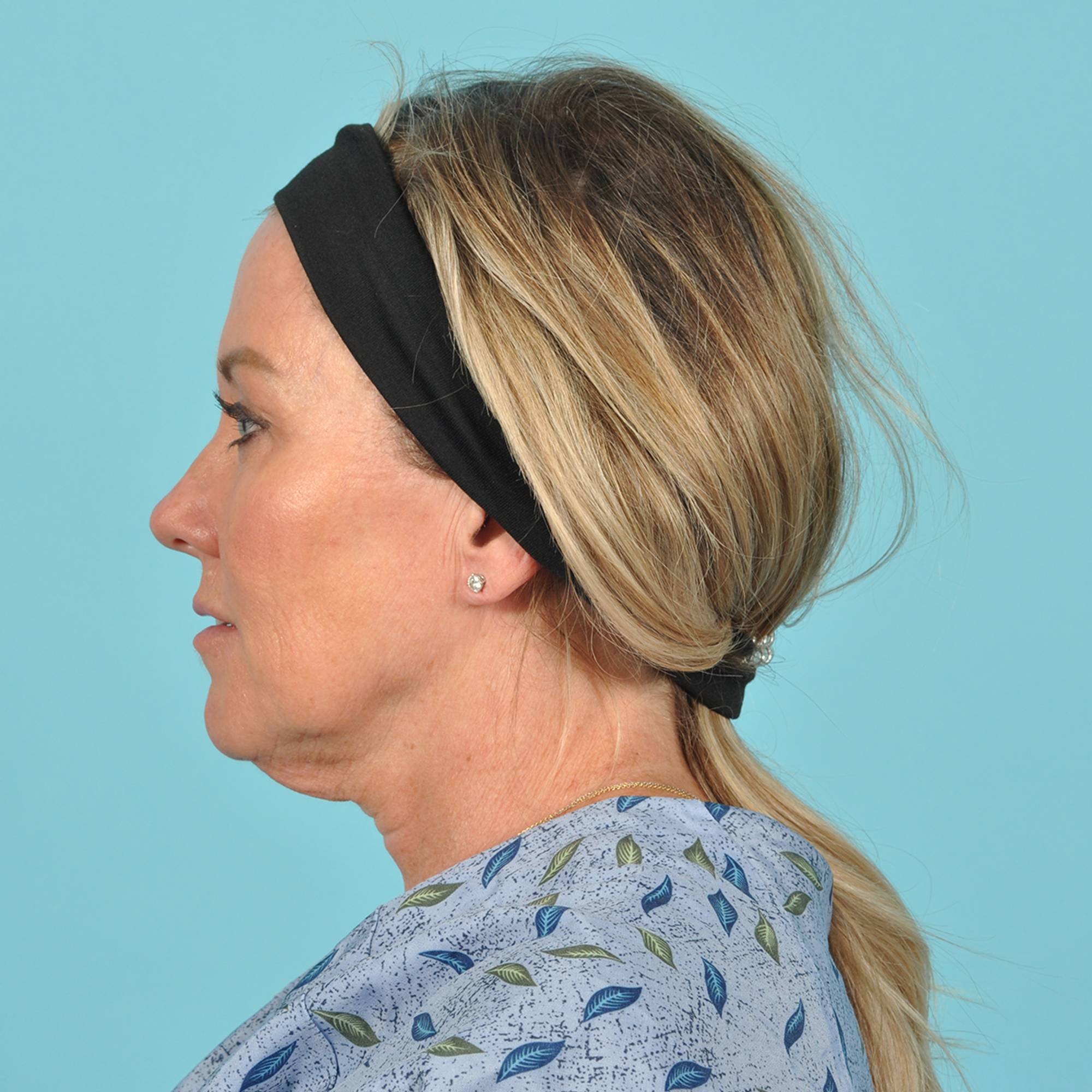 Blepharoplasty Before & After Image