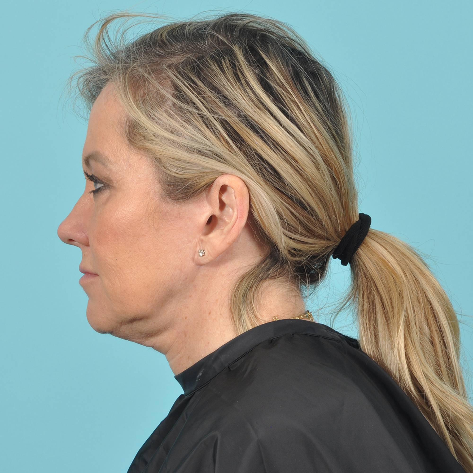 Blepharoplasty Before & After Image