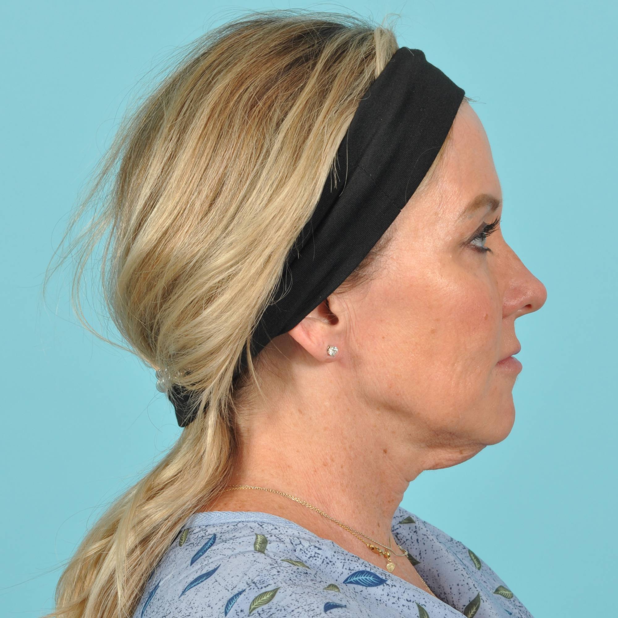 Blepharoplasty Before & After Image