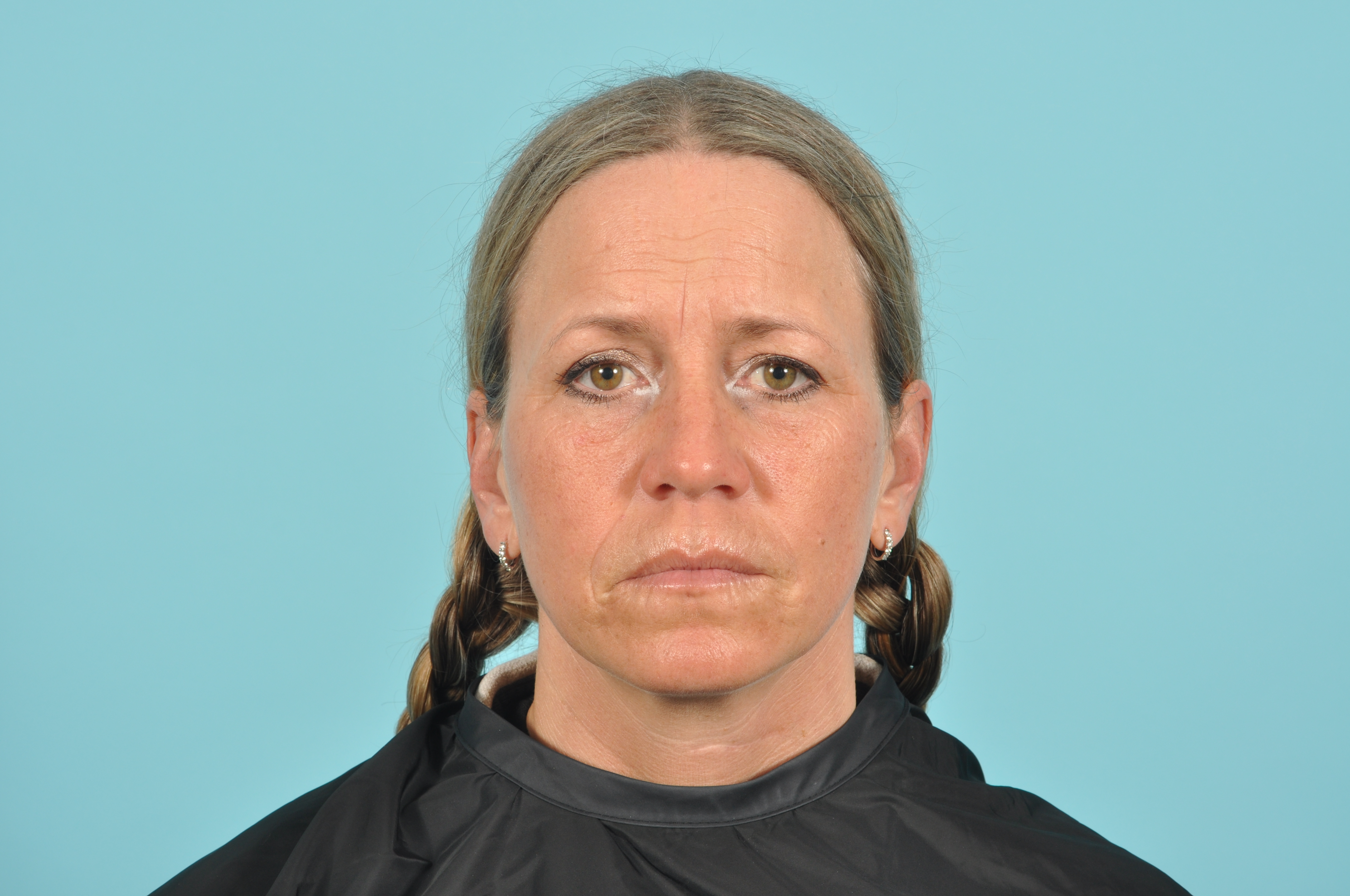 Blepharoplasty Before & After Image