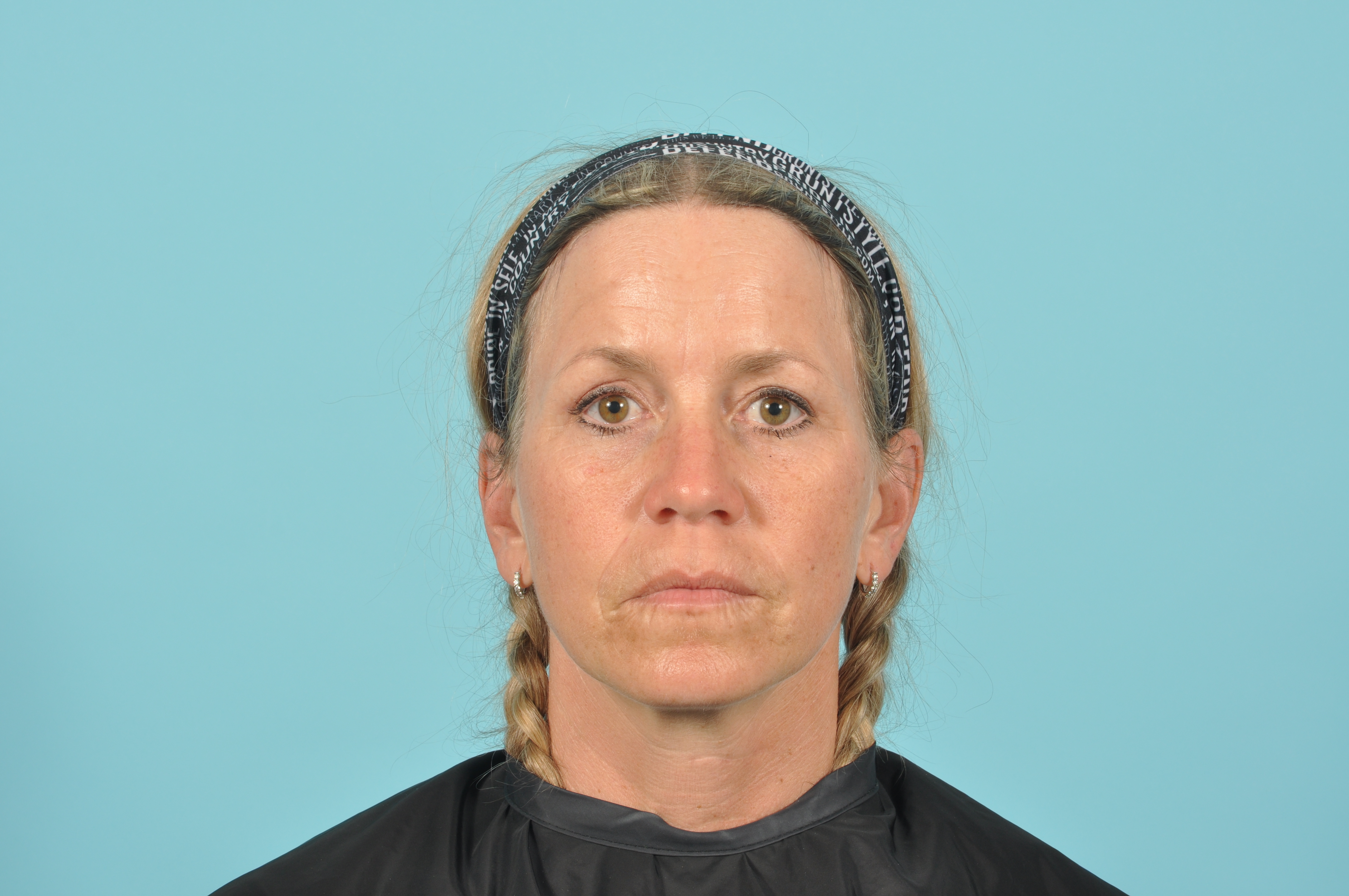 Blepharoplasty Before & After Image