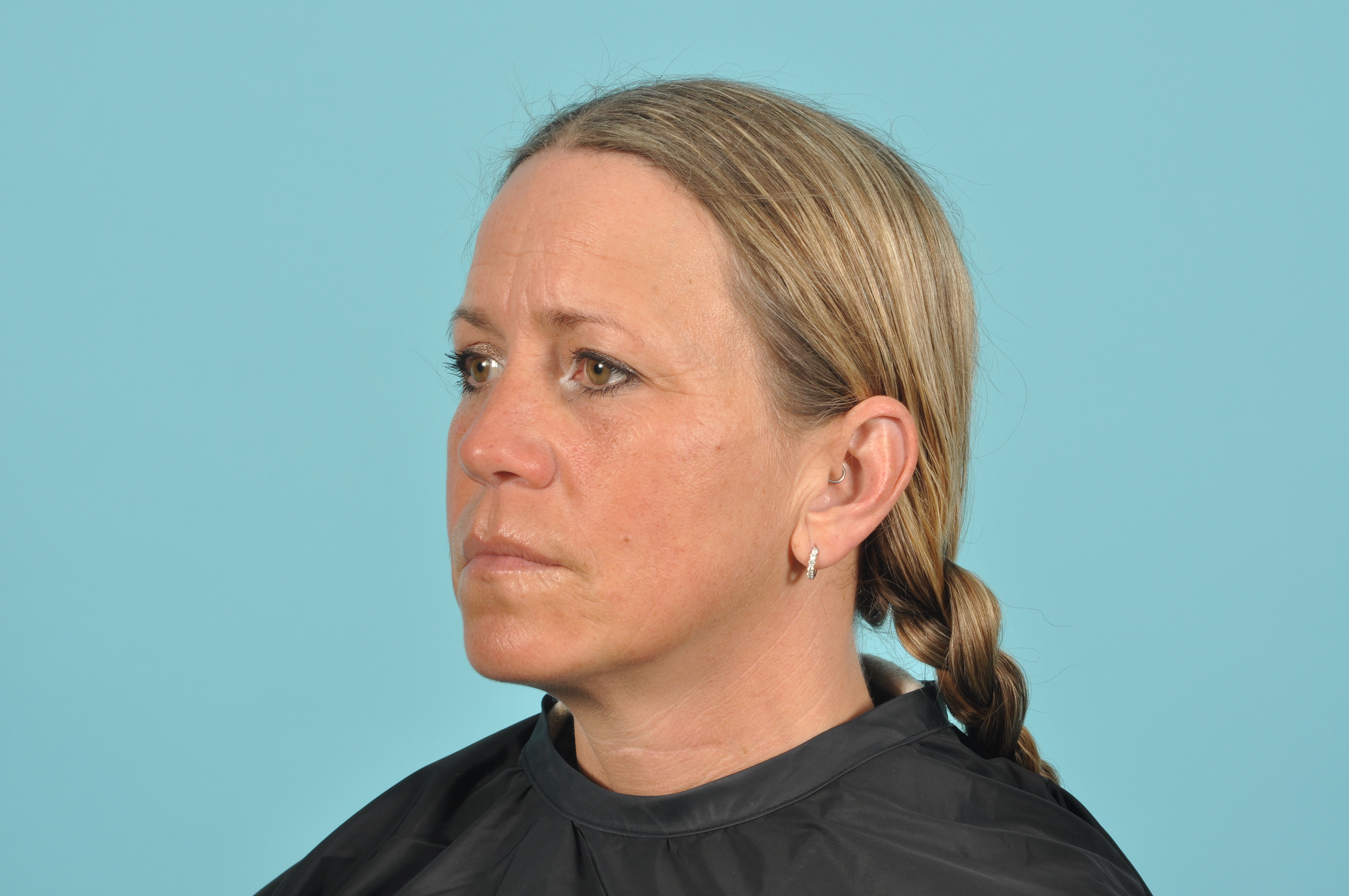 Blepharoplasty Before & After Image