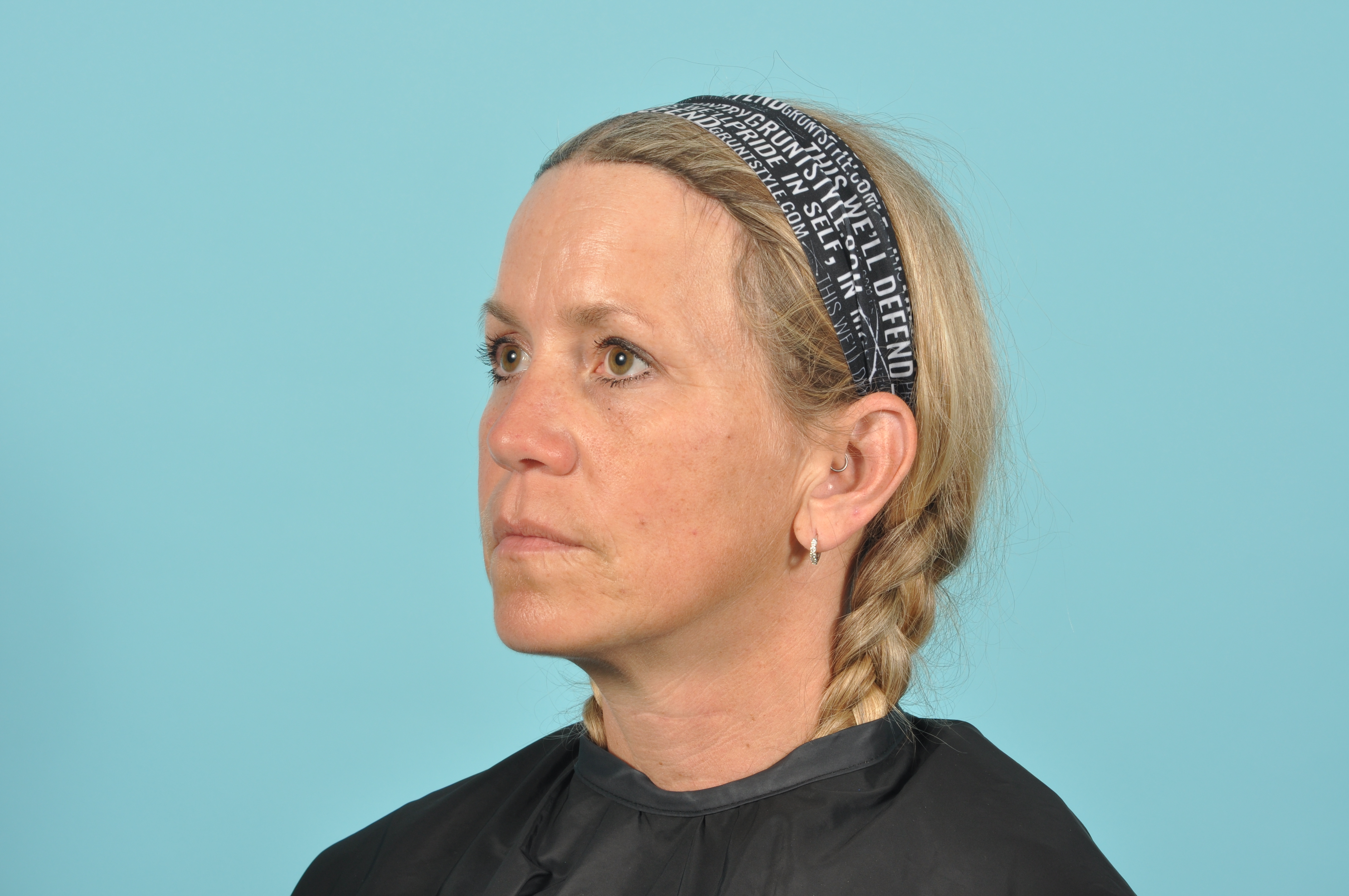 Blepharoplasty Before & After Image