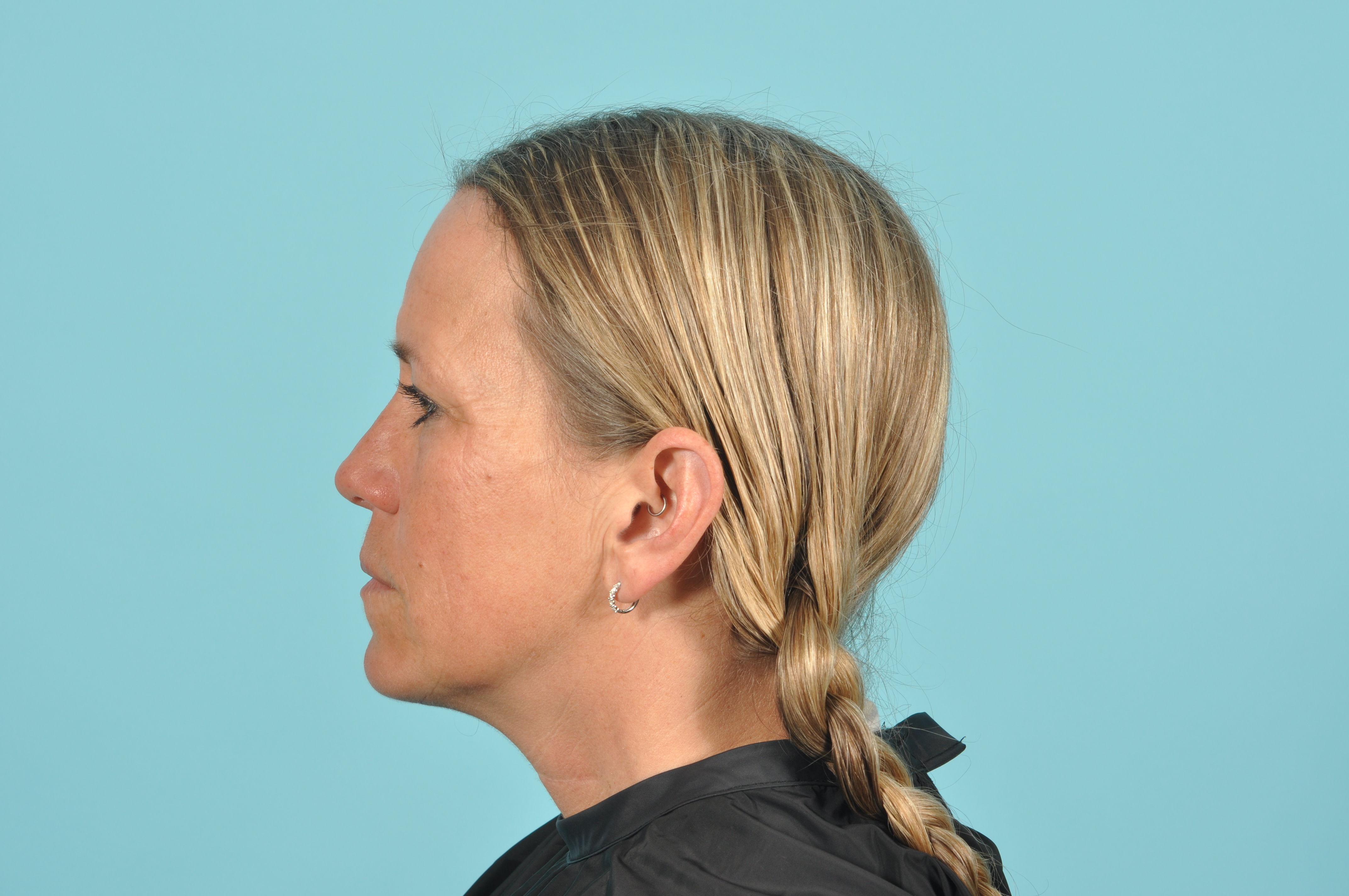 Blepharoplasty Before & After Image