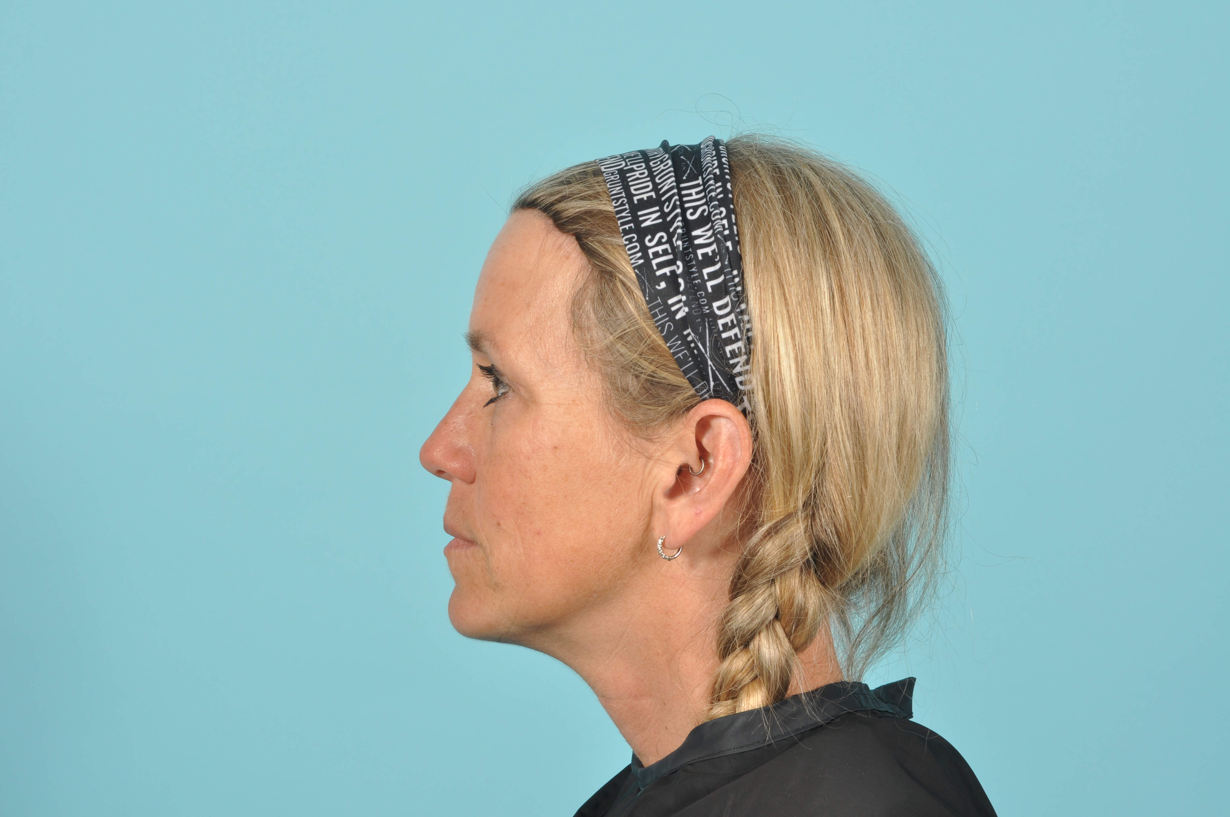 Blepharoplasty Before & After Image