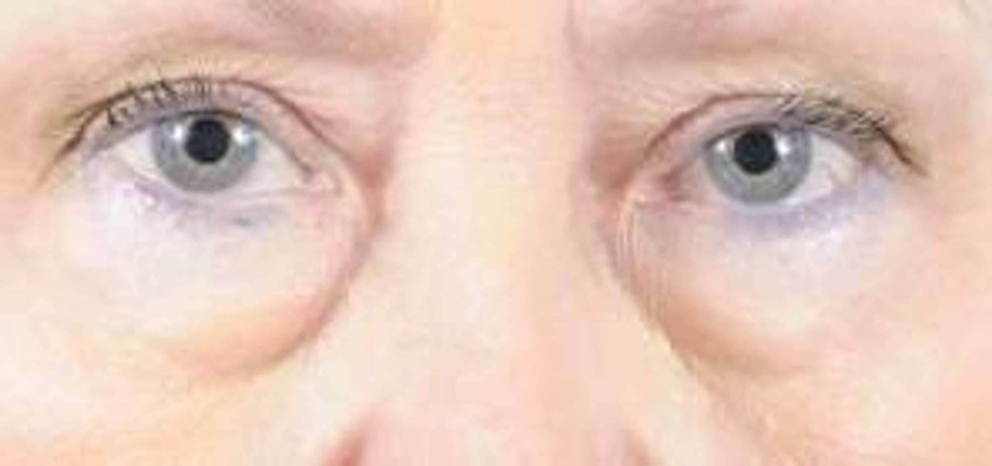 Blepharoplasty Before & After Image