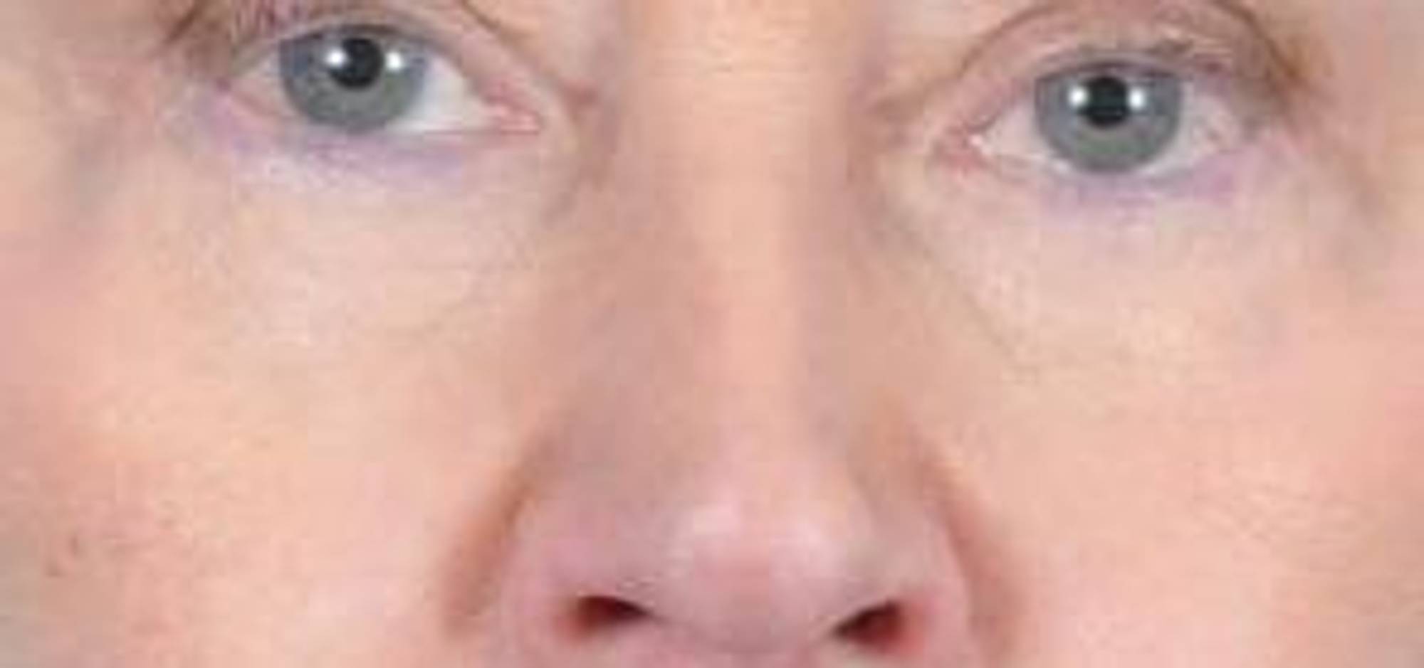 Blepharoplasty Before & After Image