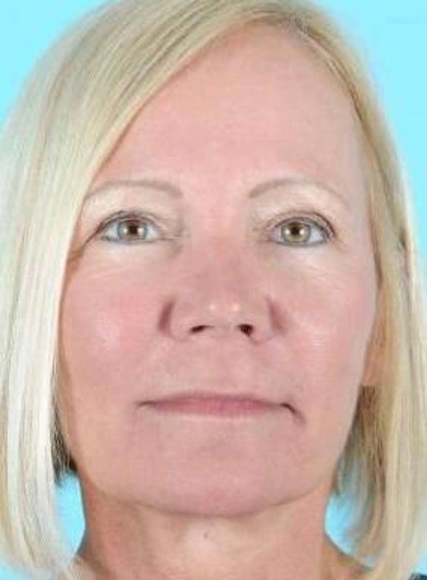 Blepharoplasty Before & After Image