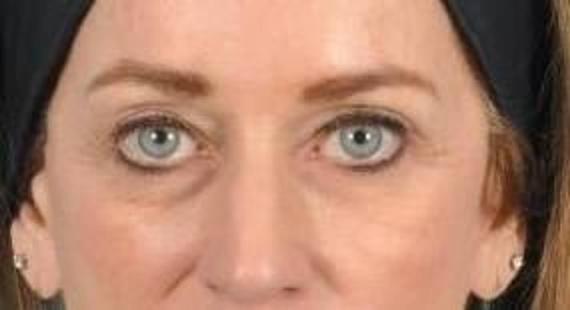 Blepharoplasty Before & After Image