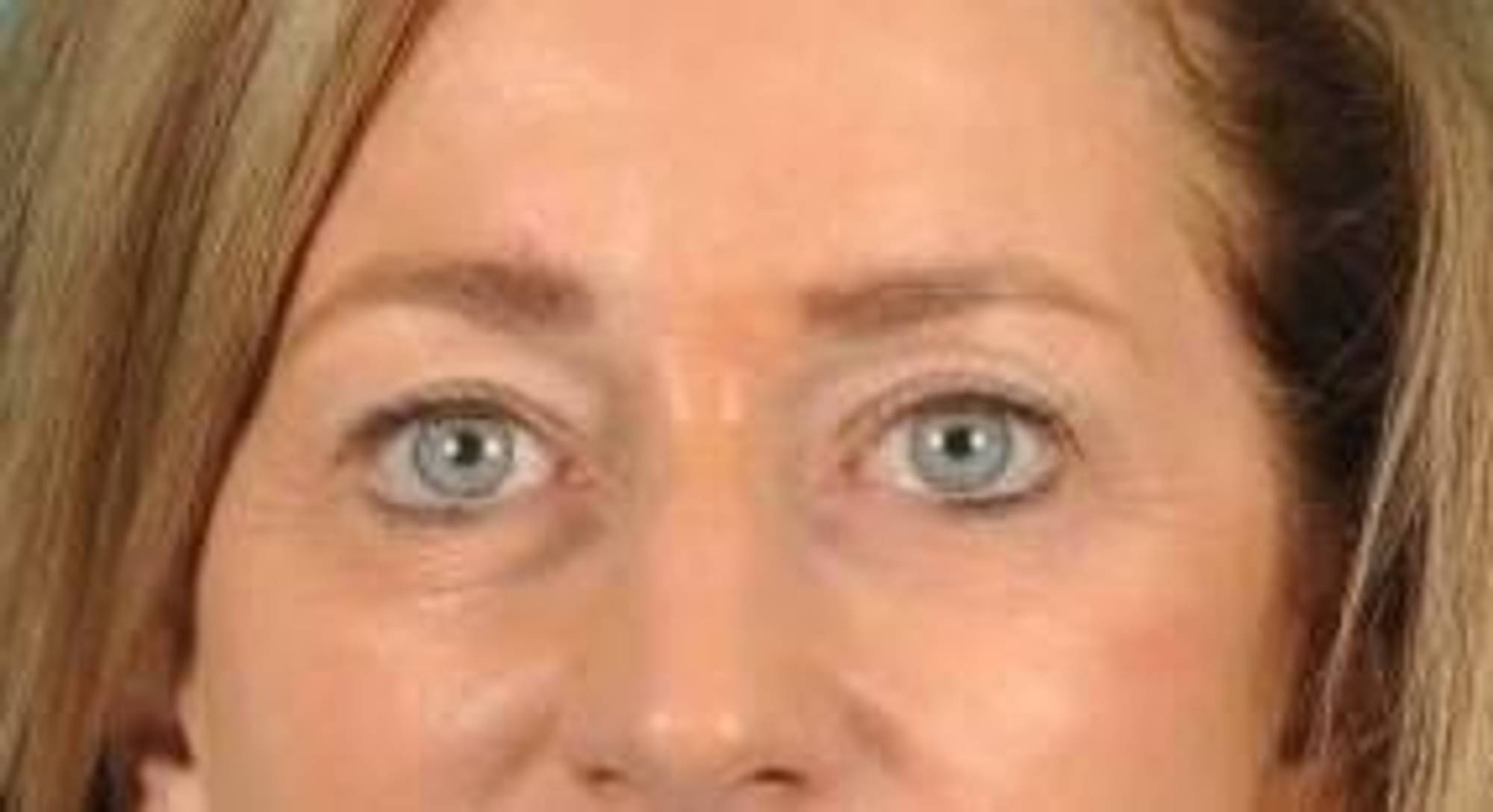 Blepharoplasty Before & After Image