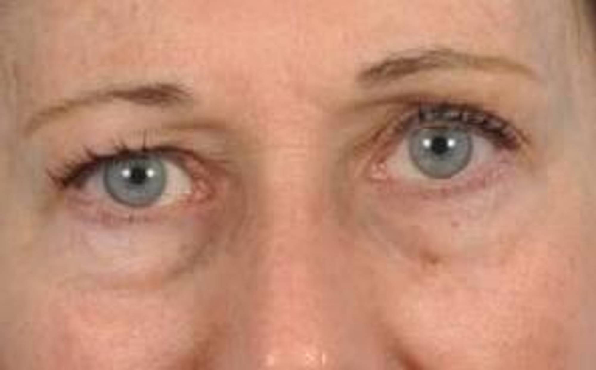 Blepharoplasty Before & After Image