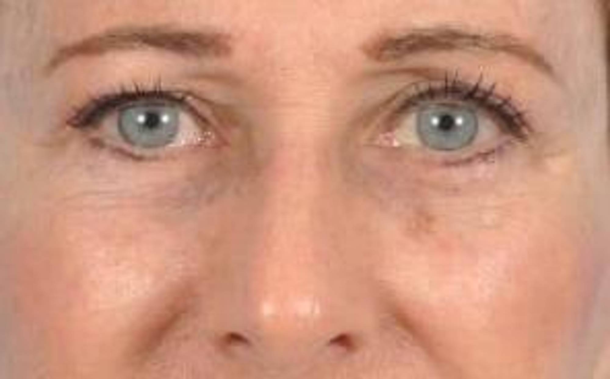 Blepharoplasty Before & After Image