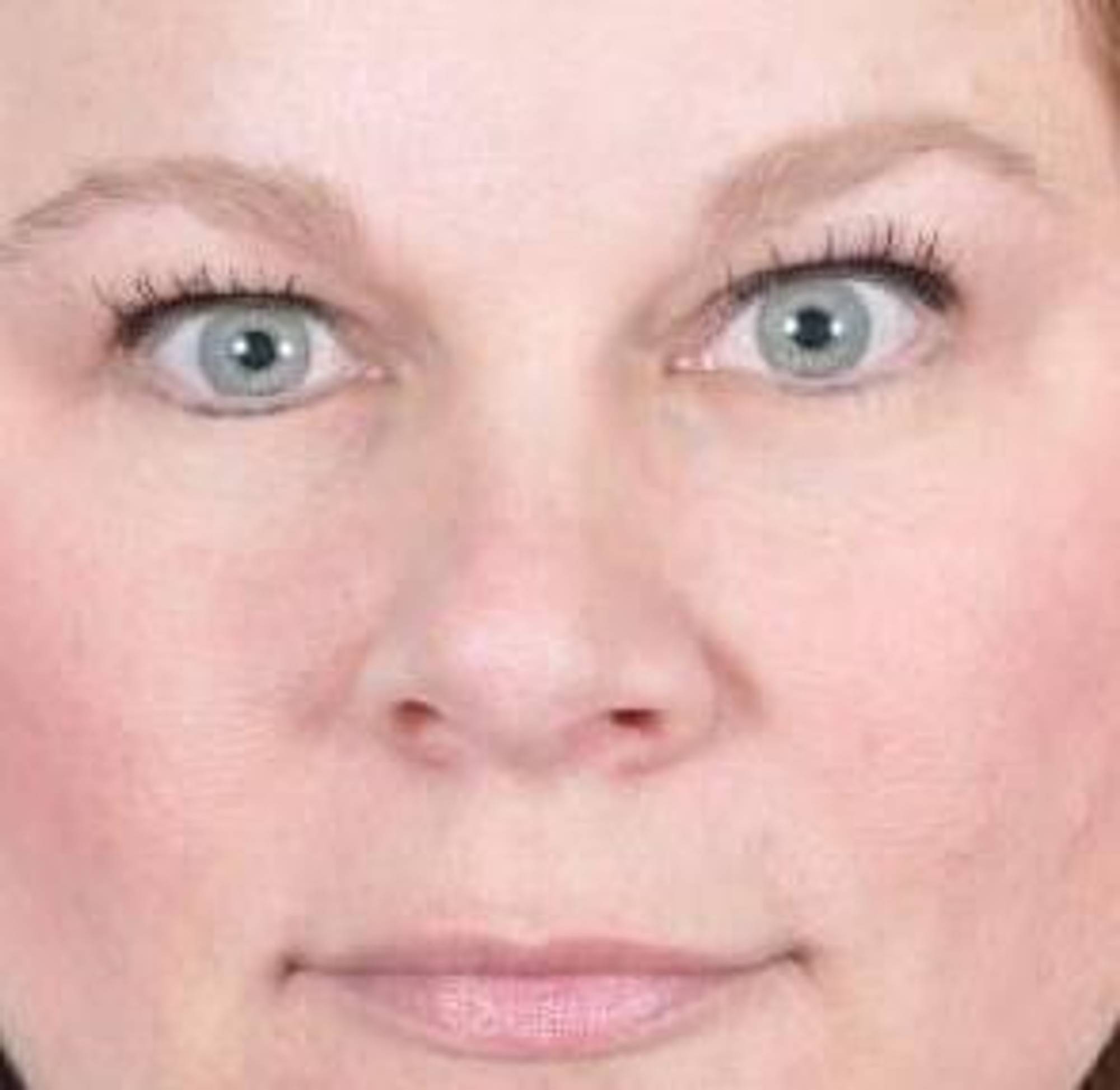 Blepharoplasty Before & After Image