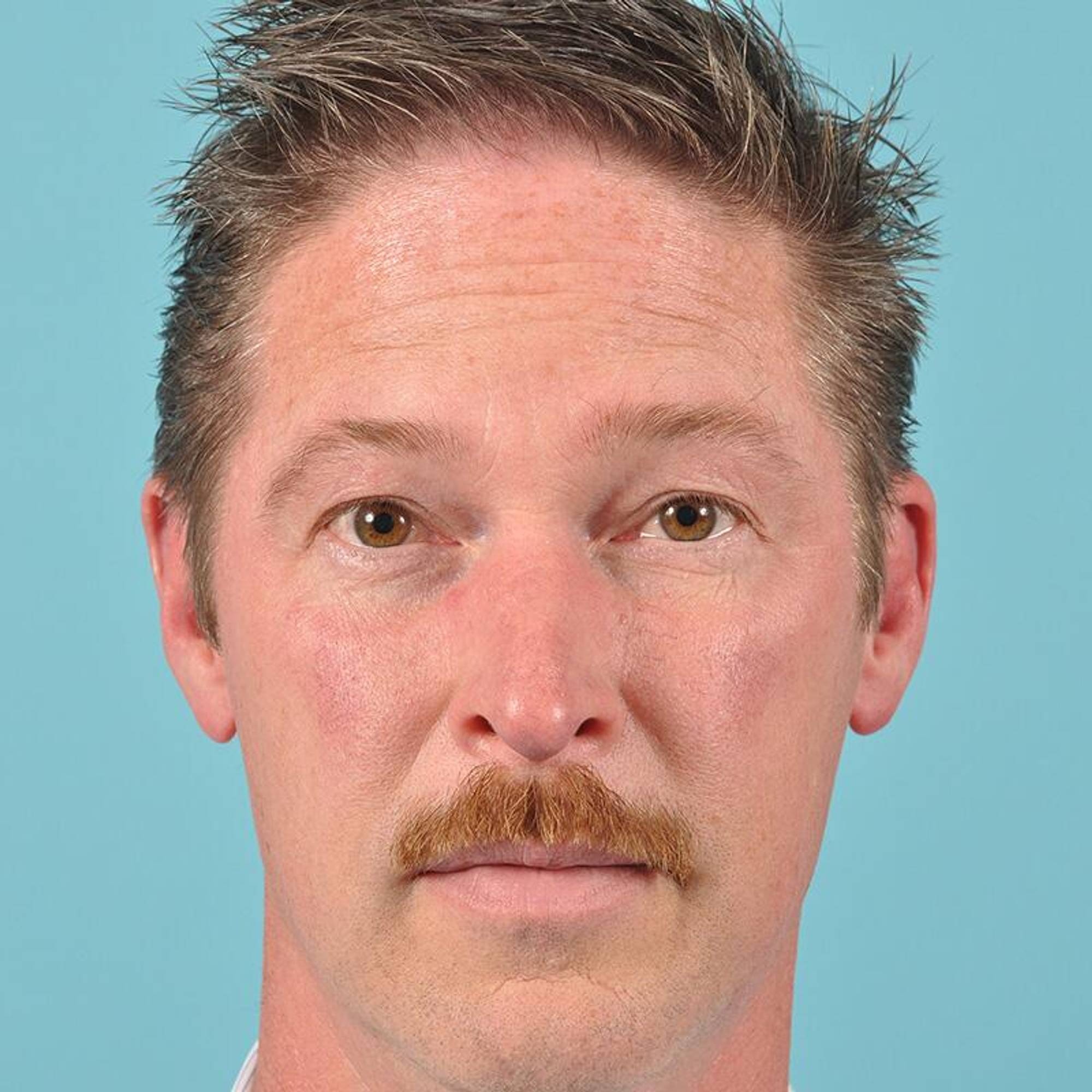 Blepharoplasty Before & After Image