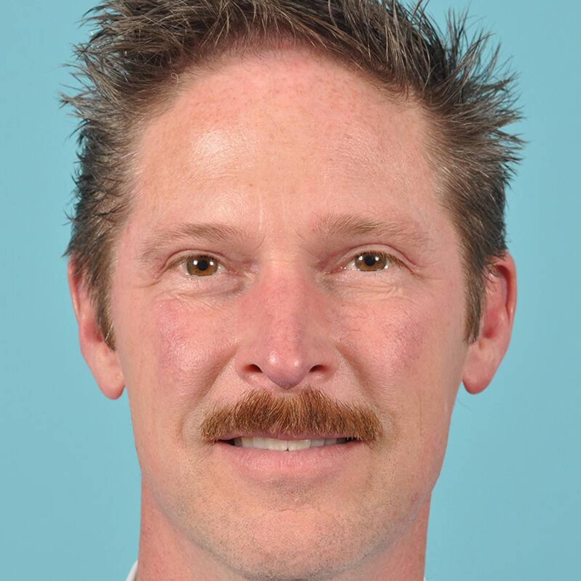 Blepharoplasty Before & After Image