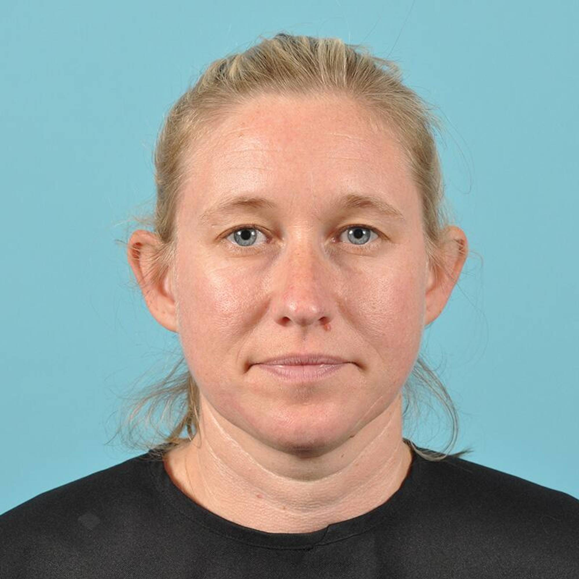 Blepharoplasty Before & After Image