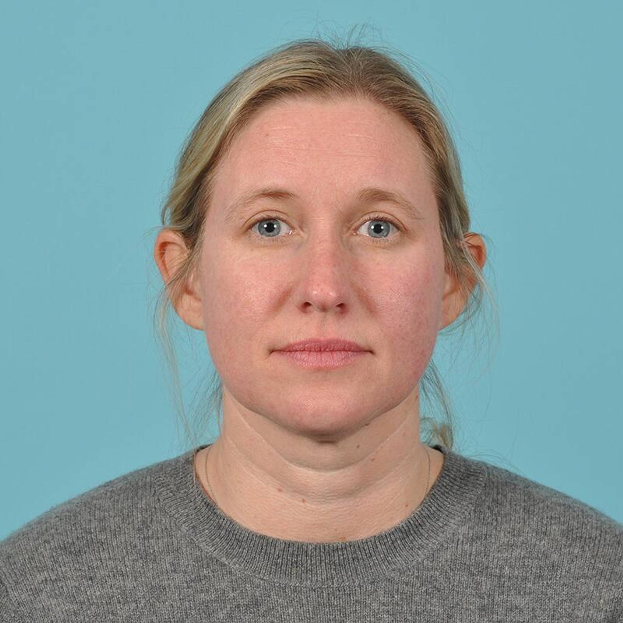 Blepharoplasty Before & After Image