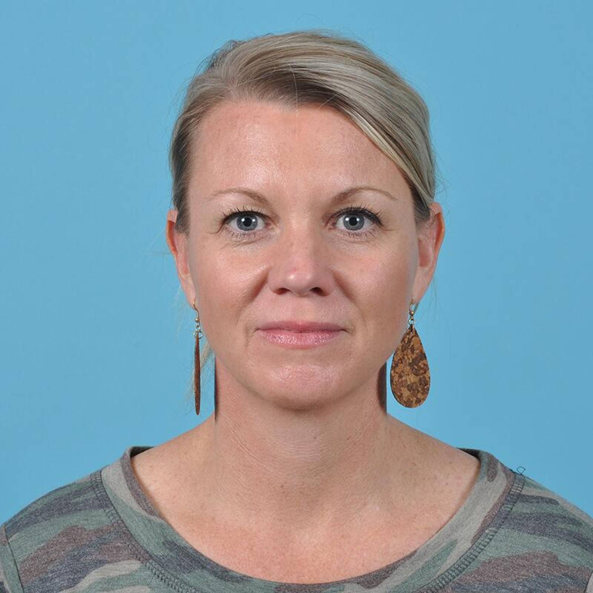 Blepharoplasty Before & After Image