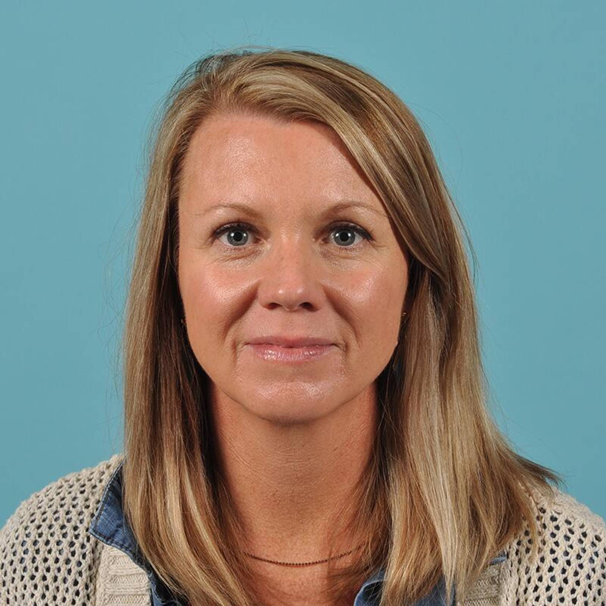 Blepharoplasty Before & After Image