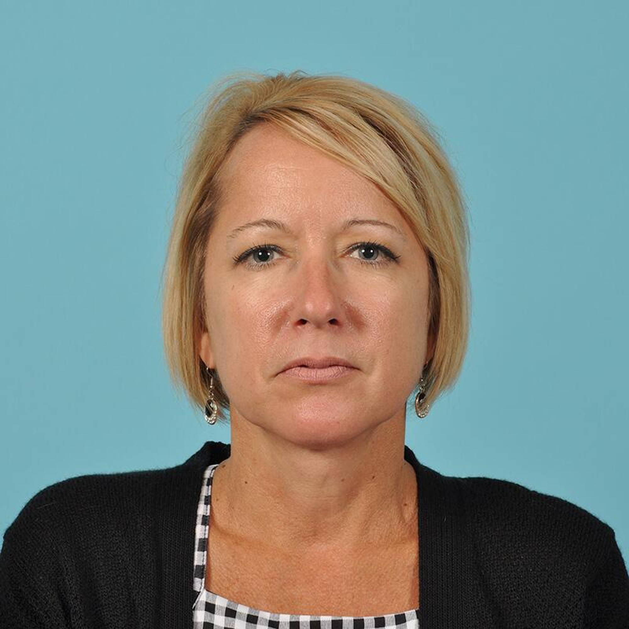 Blepharoplasty Before & After Image