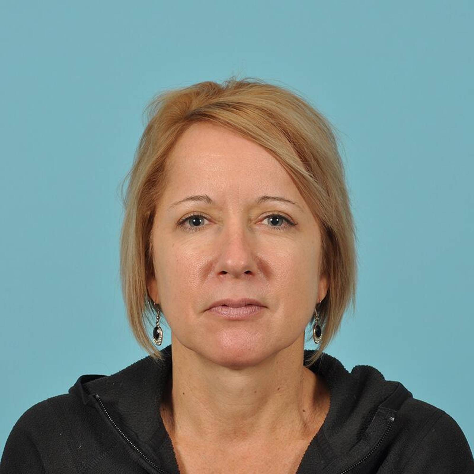 Blepharoplasty Before & After Image