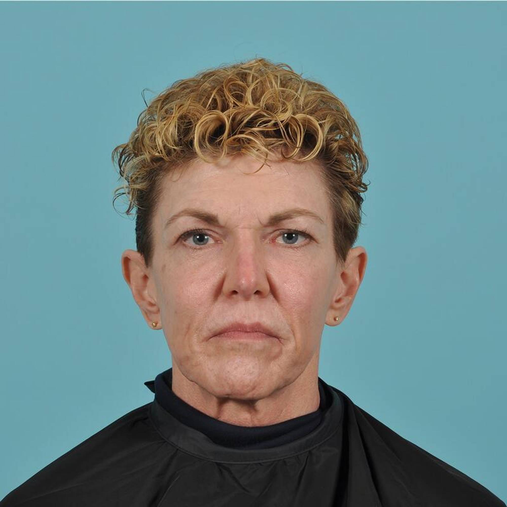 Blepharoplasty Before & After Image