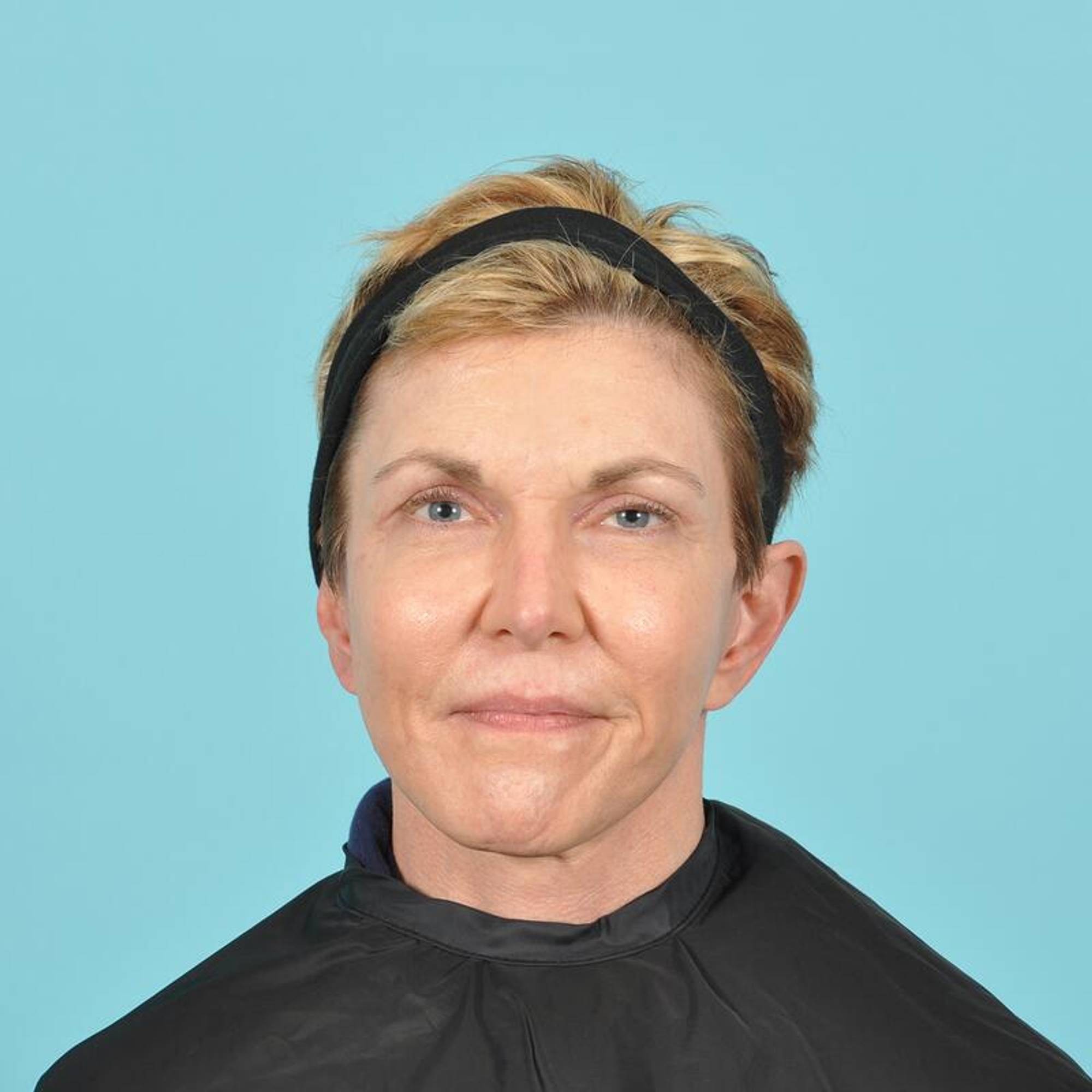 Blepharoplasty Before & After Image