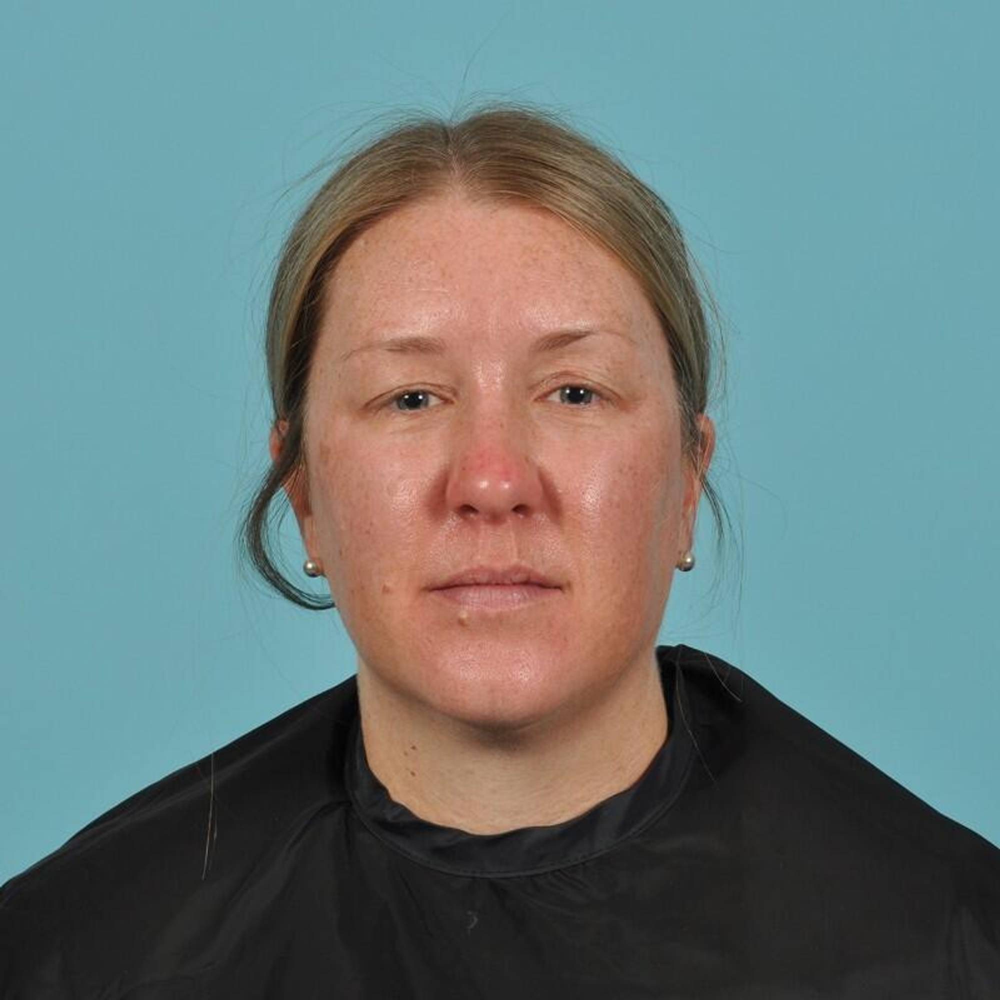 Blepharoplasty Before & After Image