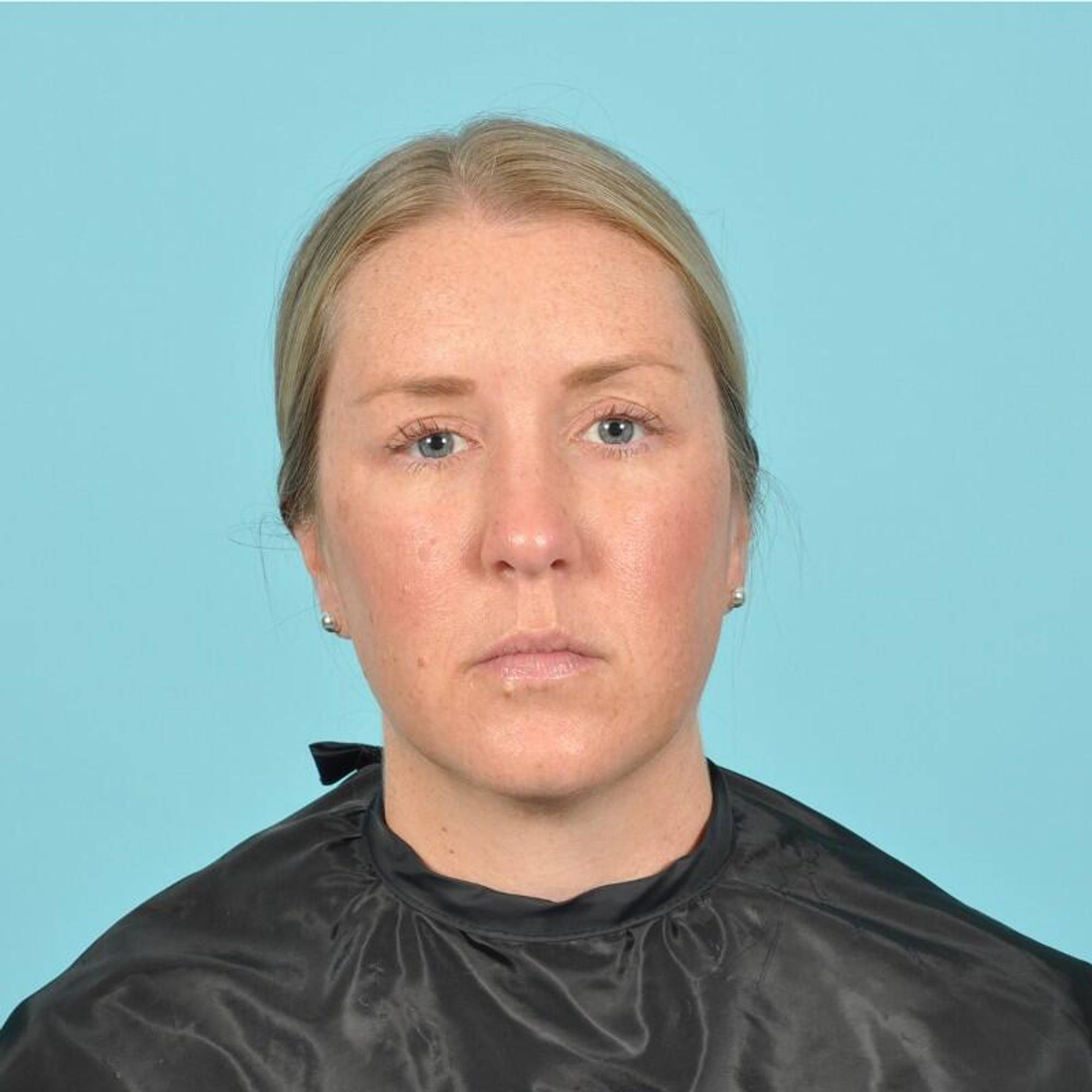 Blepharoplasty Before & After Image