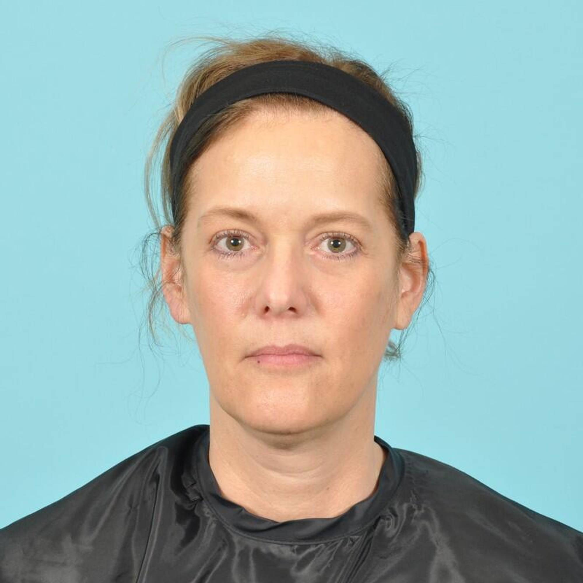 Blepharoplasty Before & After Image