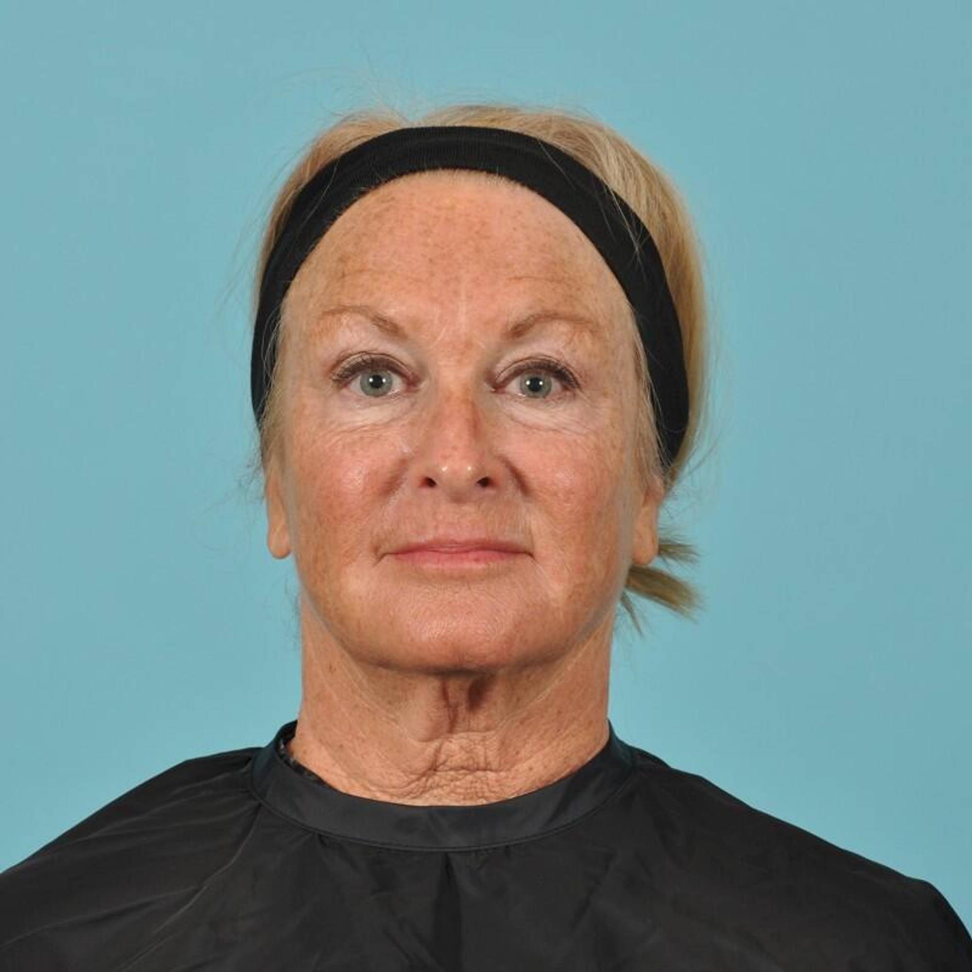 Blepharoplasty Before & After Image