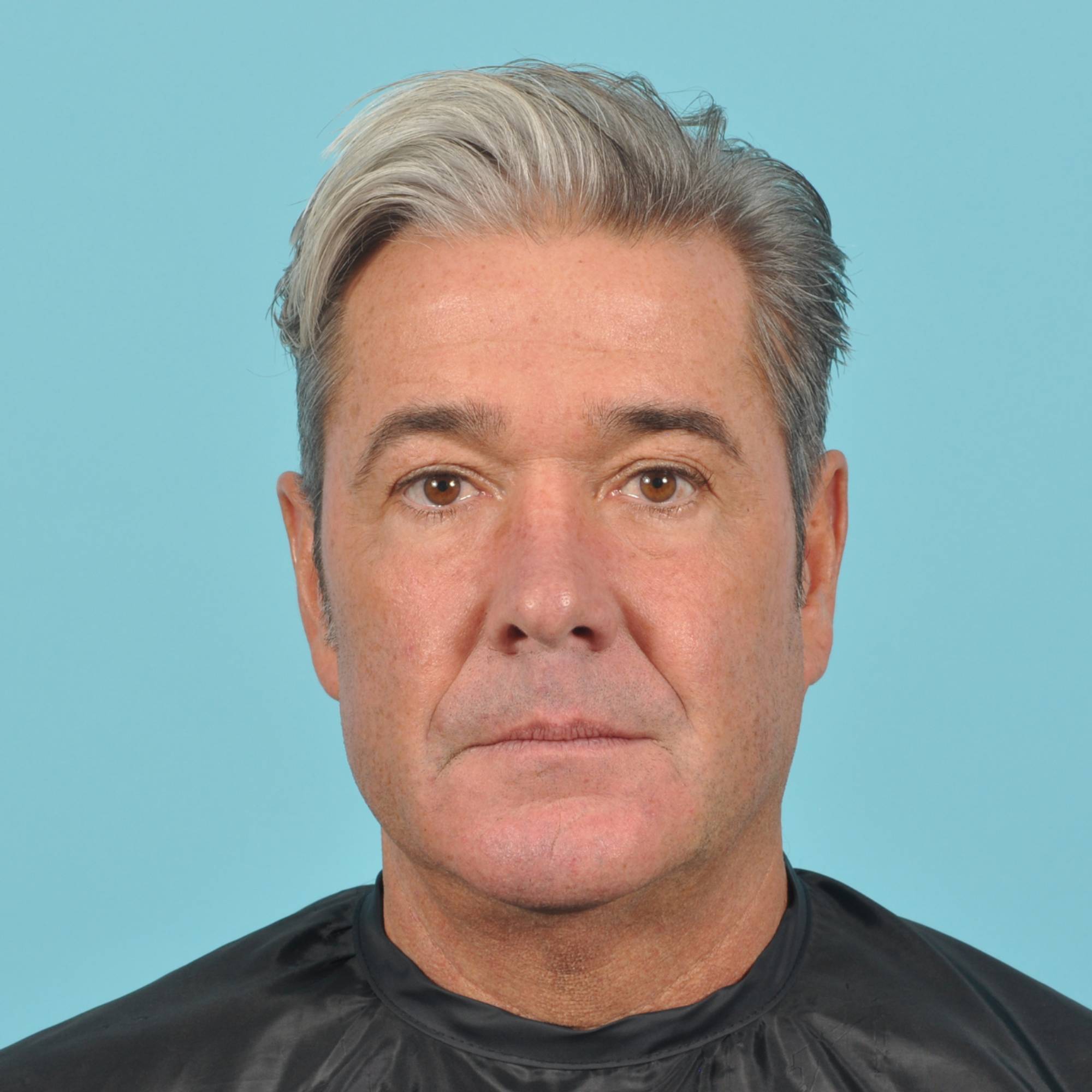 Blepharoplasty Before & After Image