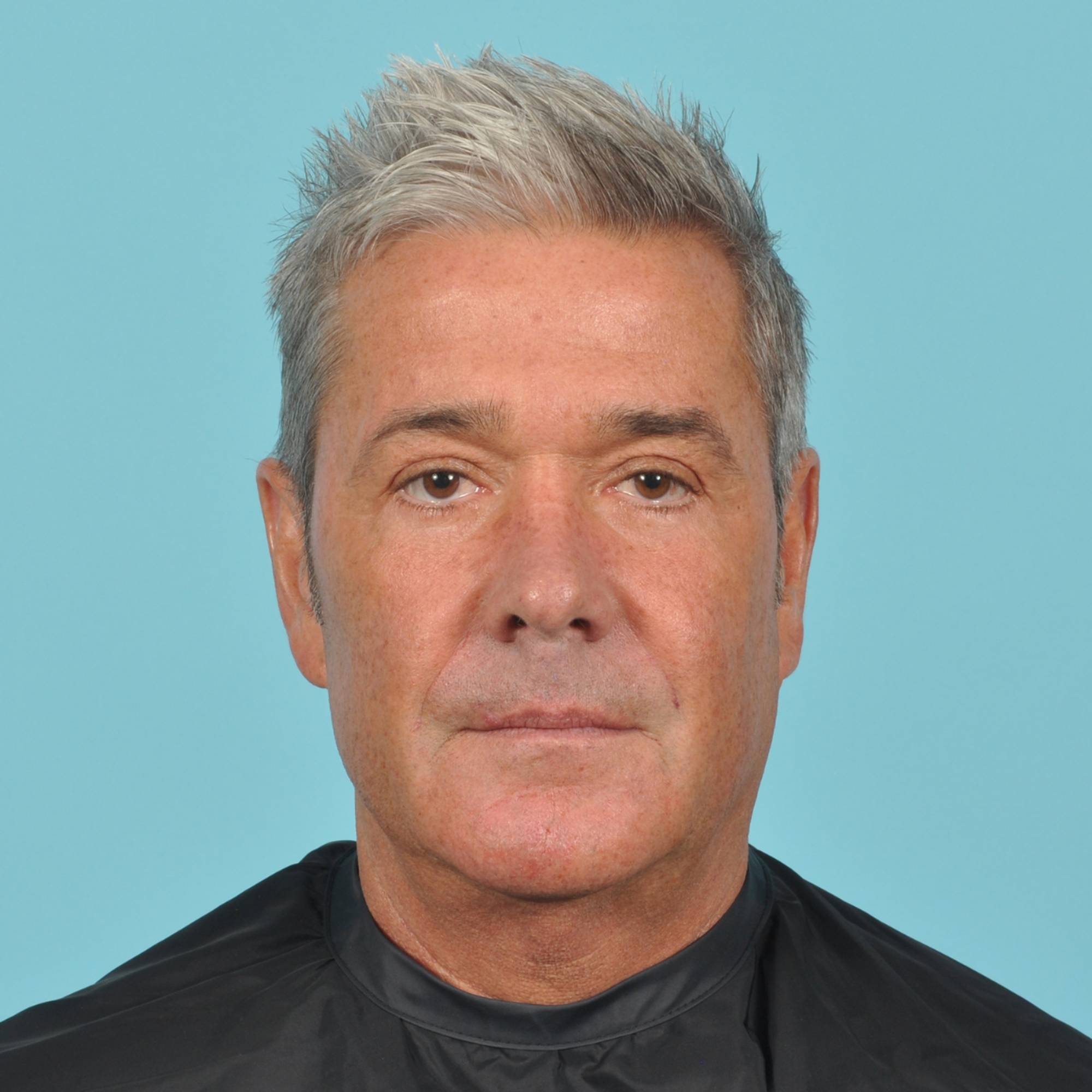 Blepharoplasty Before & After Image