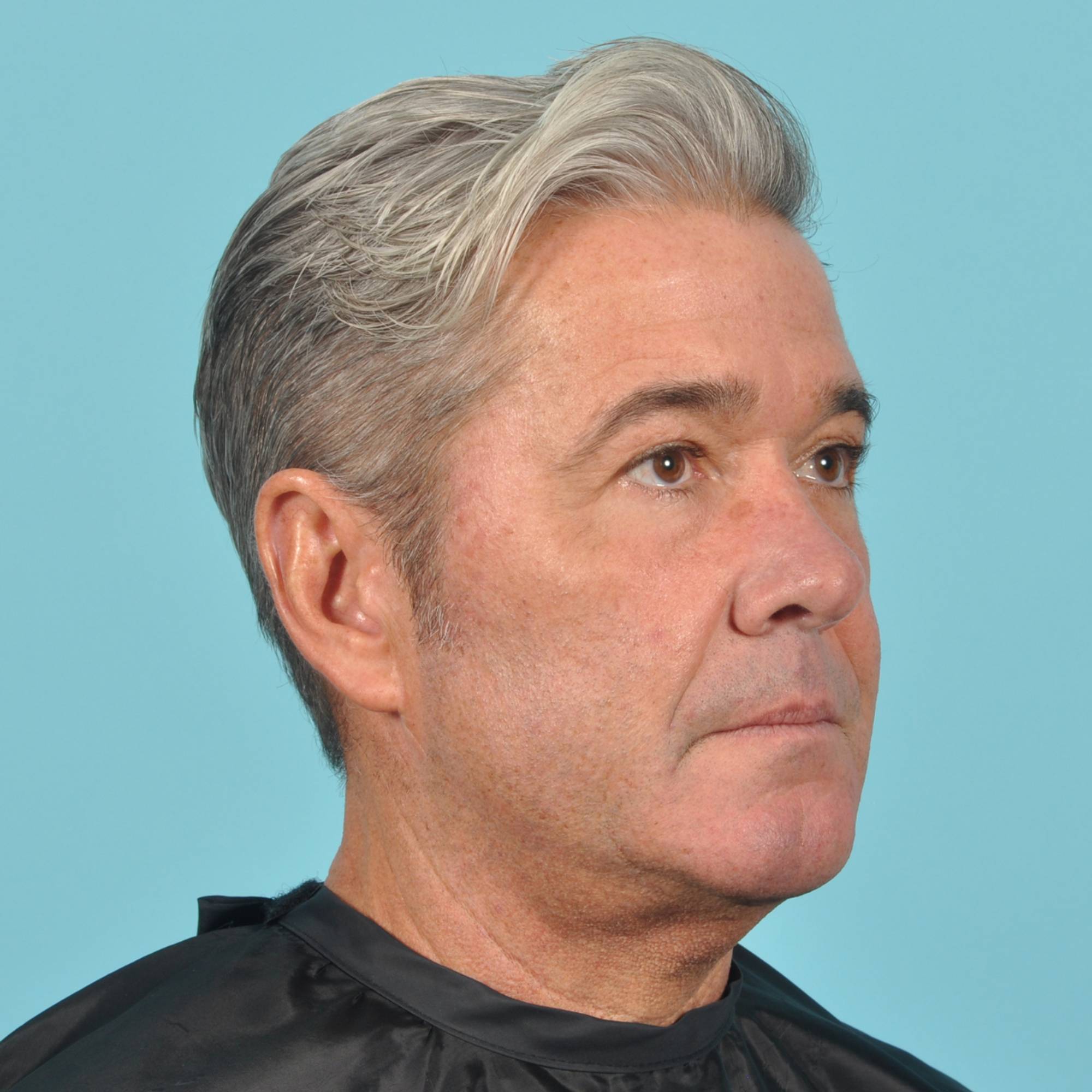 Blepharoplasty Before & After Image