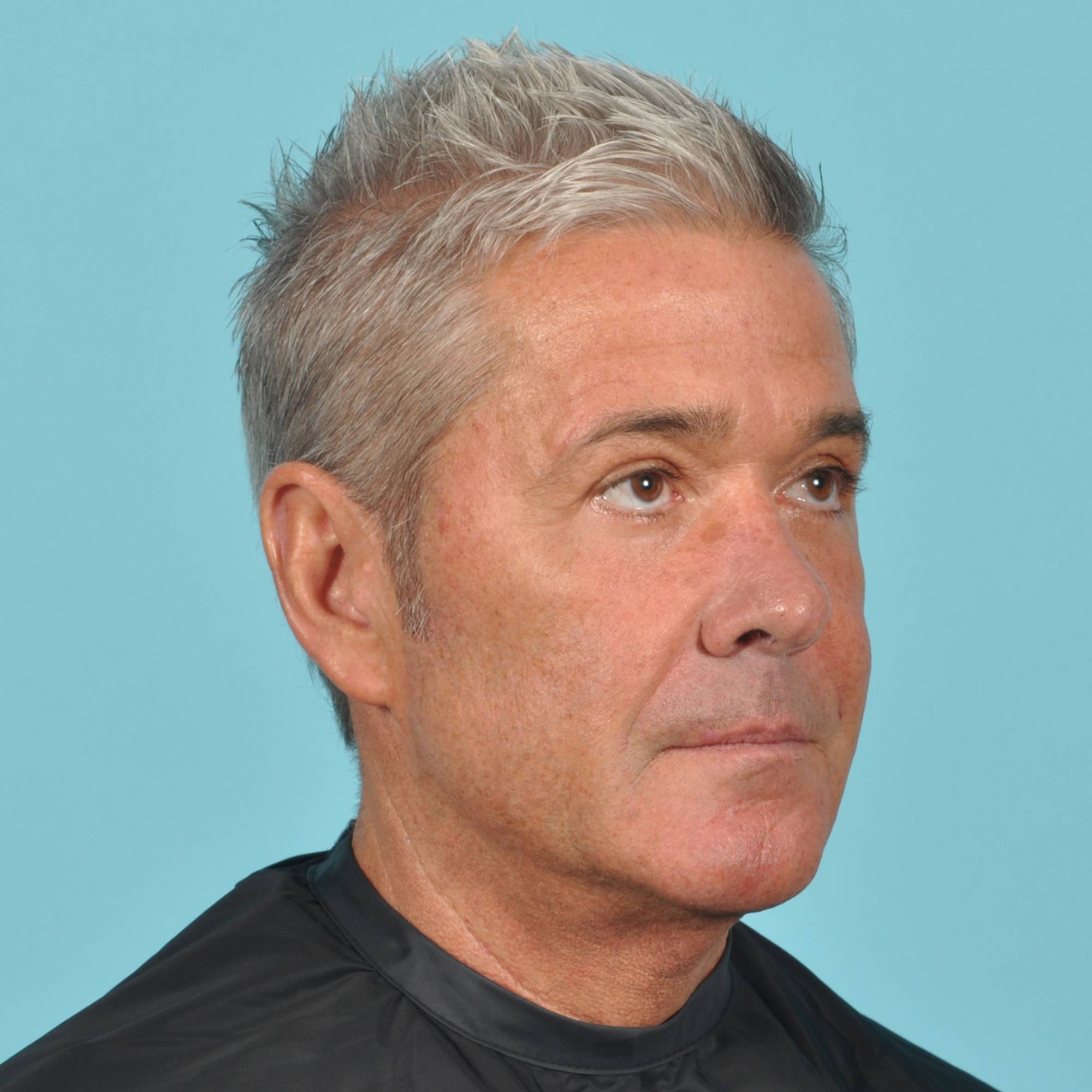 Blepharoplasty Before & After Image