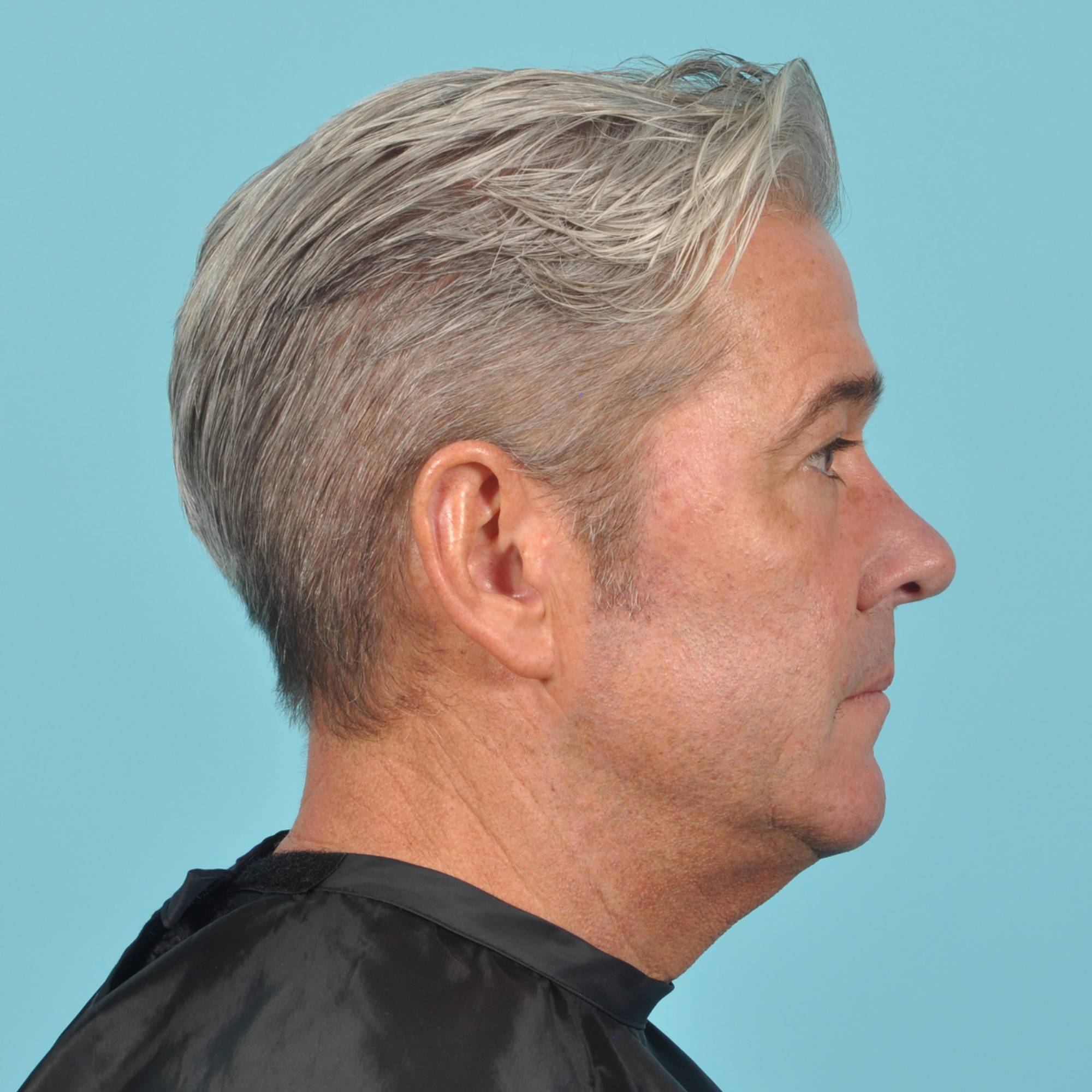 Blepharoplasty Before & After Image