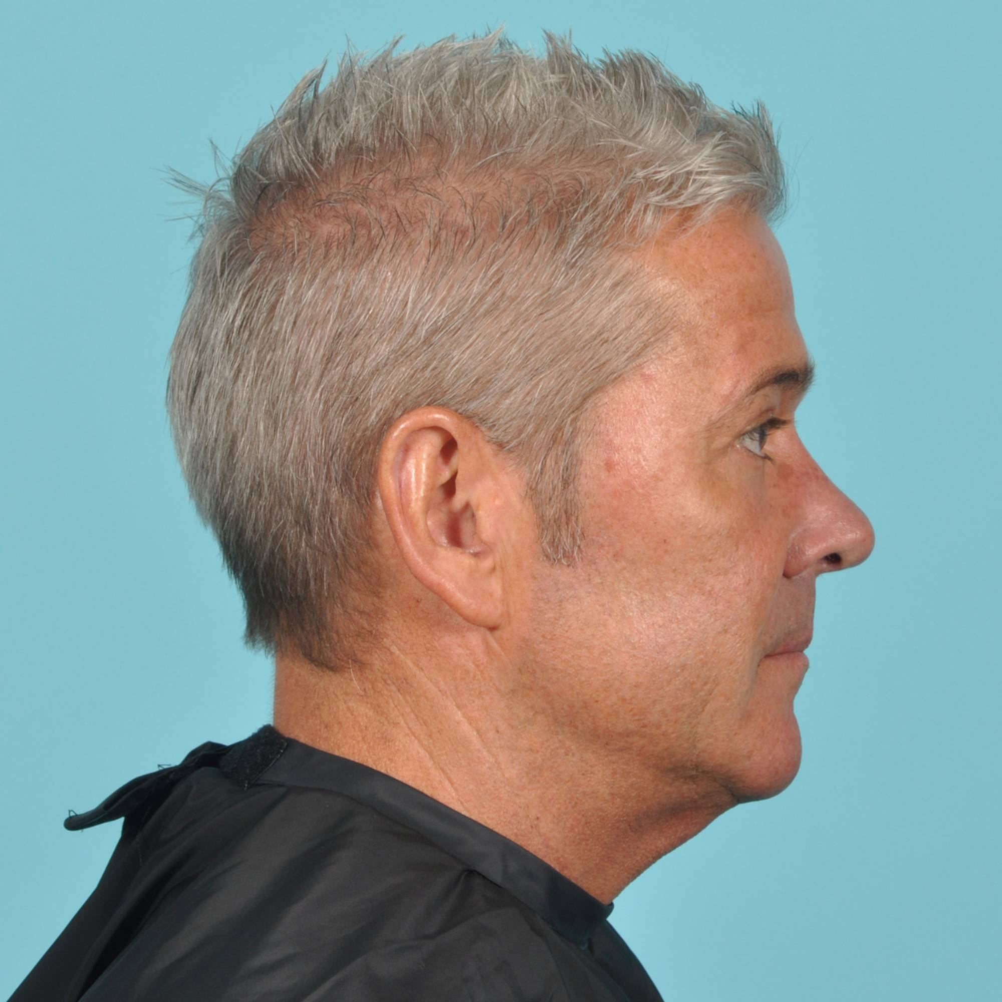 Blepharoplasty Before & After Image