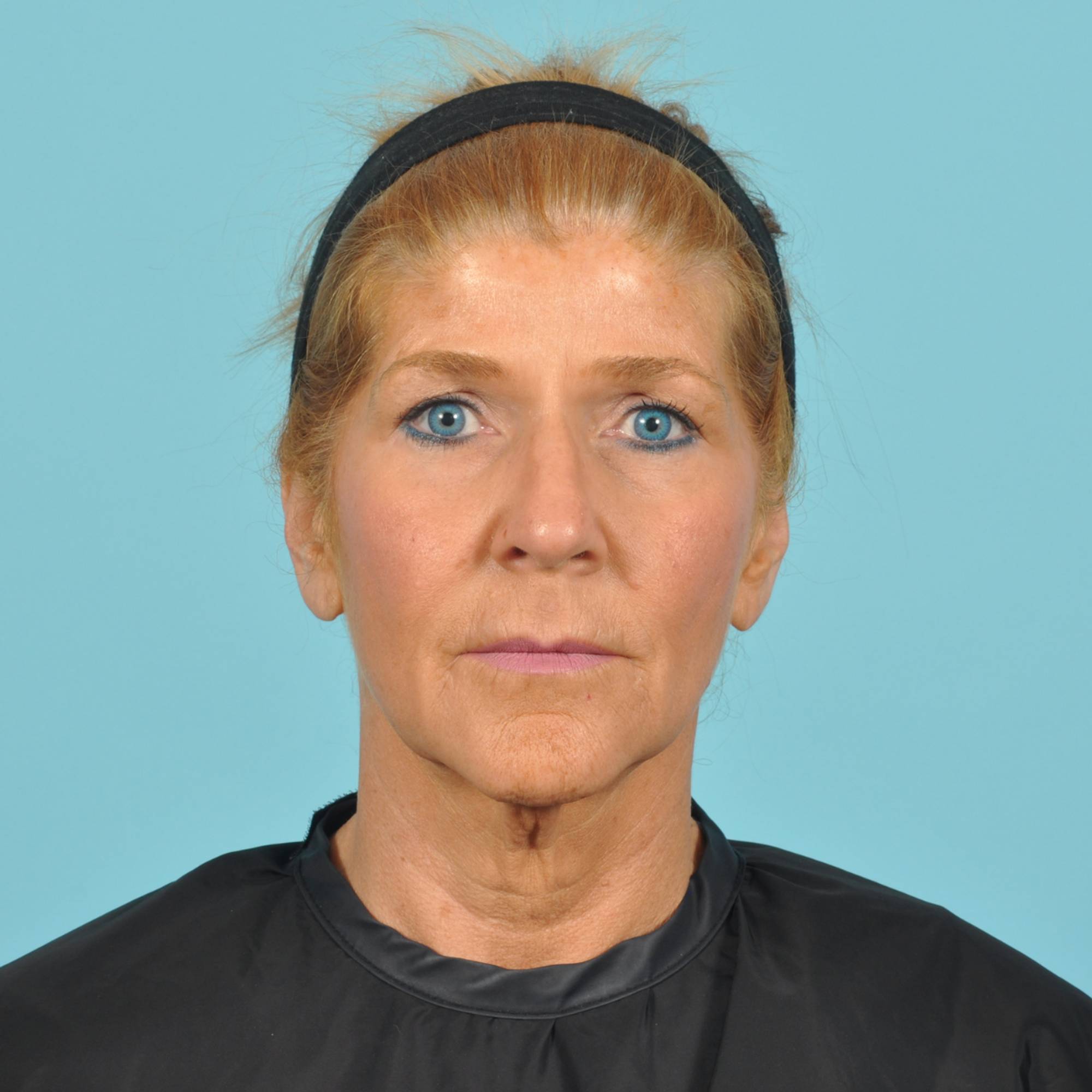 Blepharoplasty Before & After Image