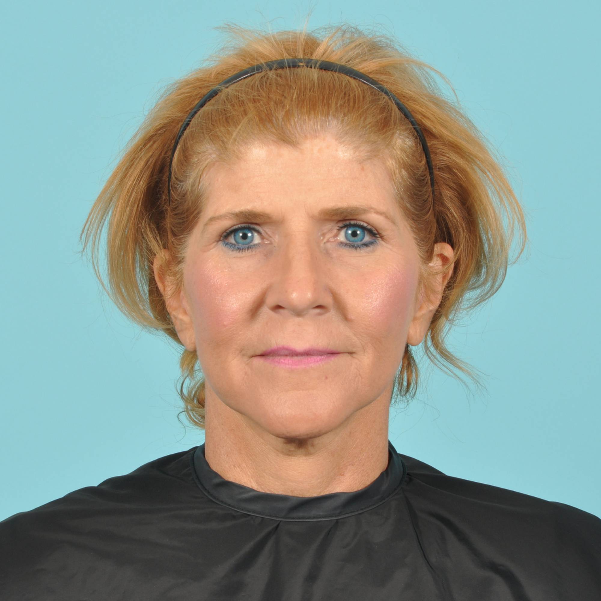 Blepharoplasty Before & After Image