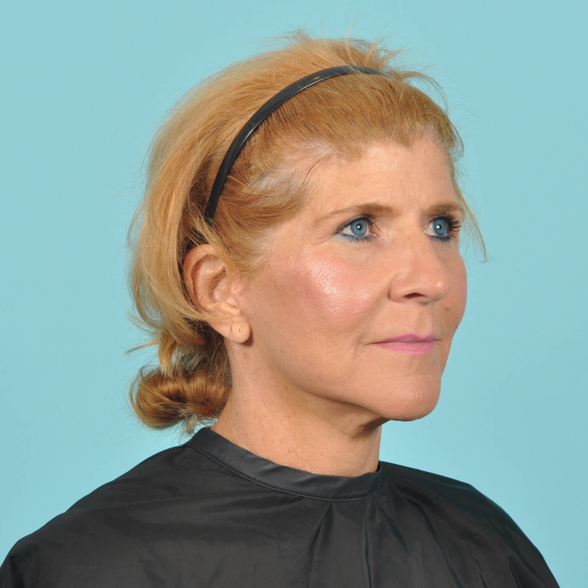 Blepharoplasty Before & After Image