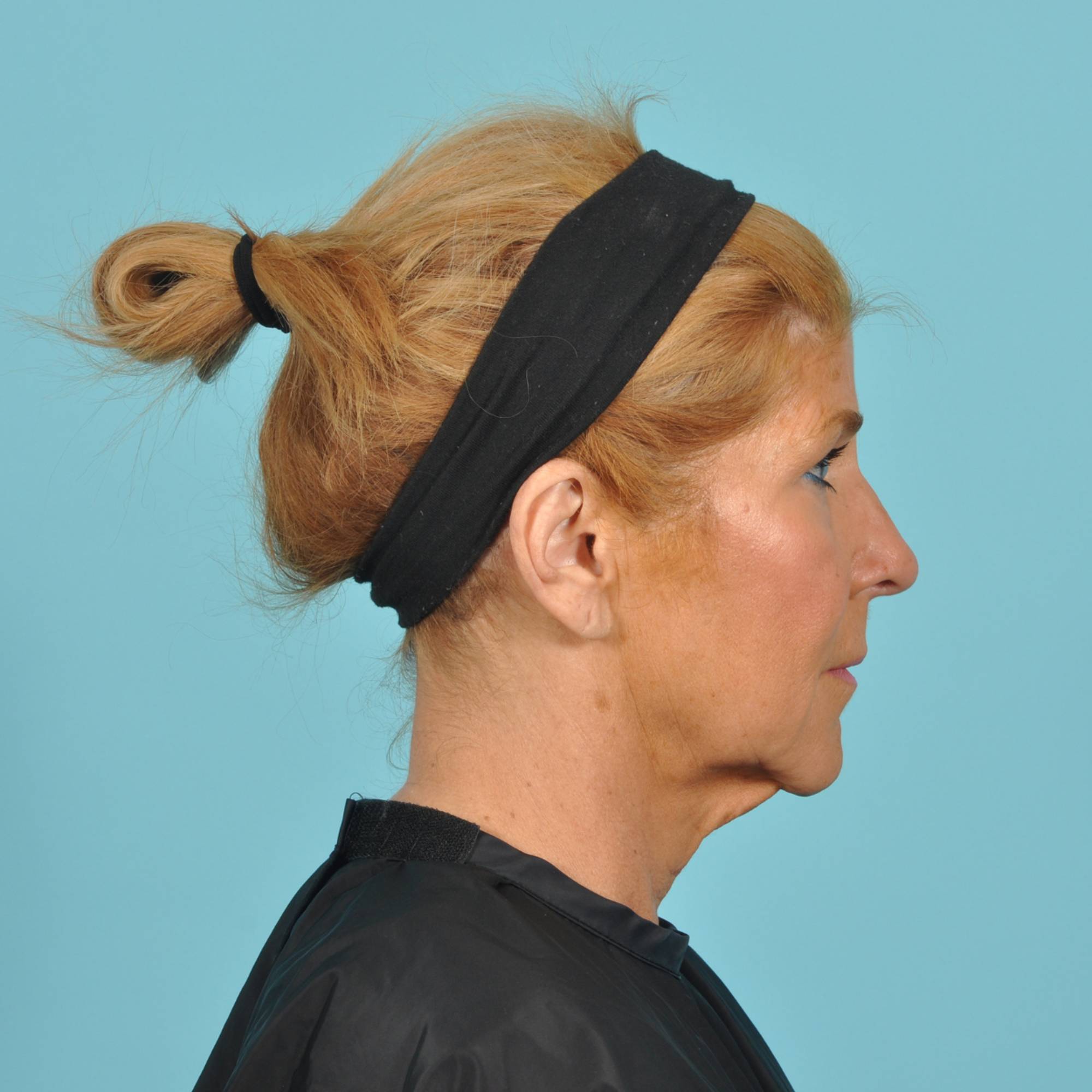 Blepharoplasty Before & After Image