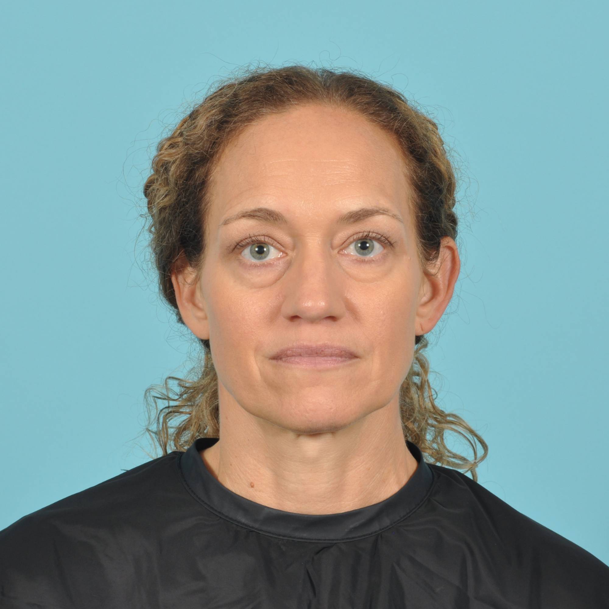 Blepharoplasty Before & After Image