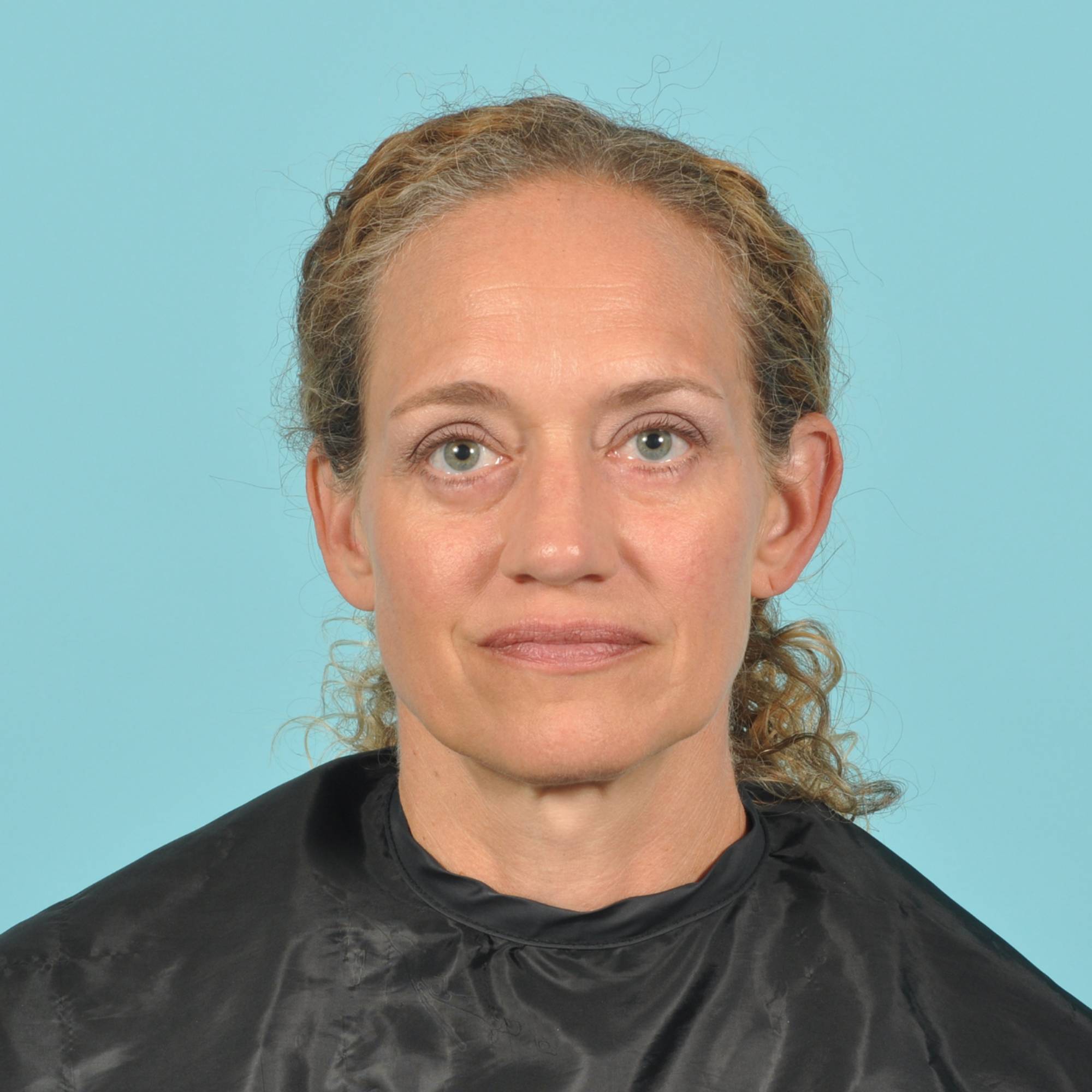 Blepharoplasty Before & After Image