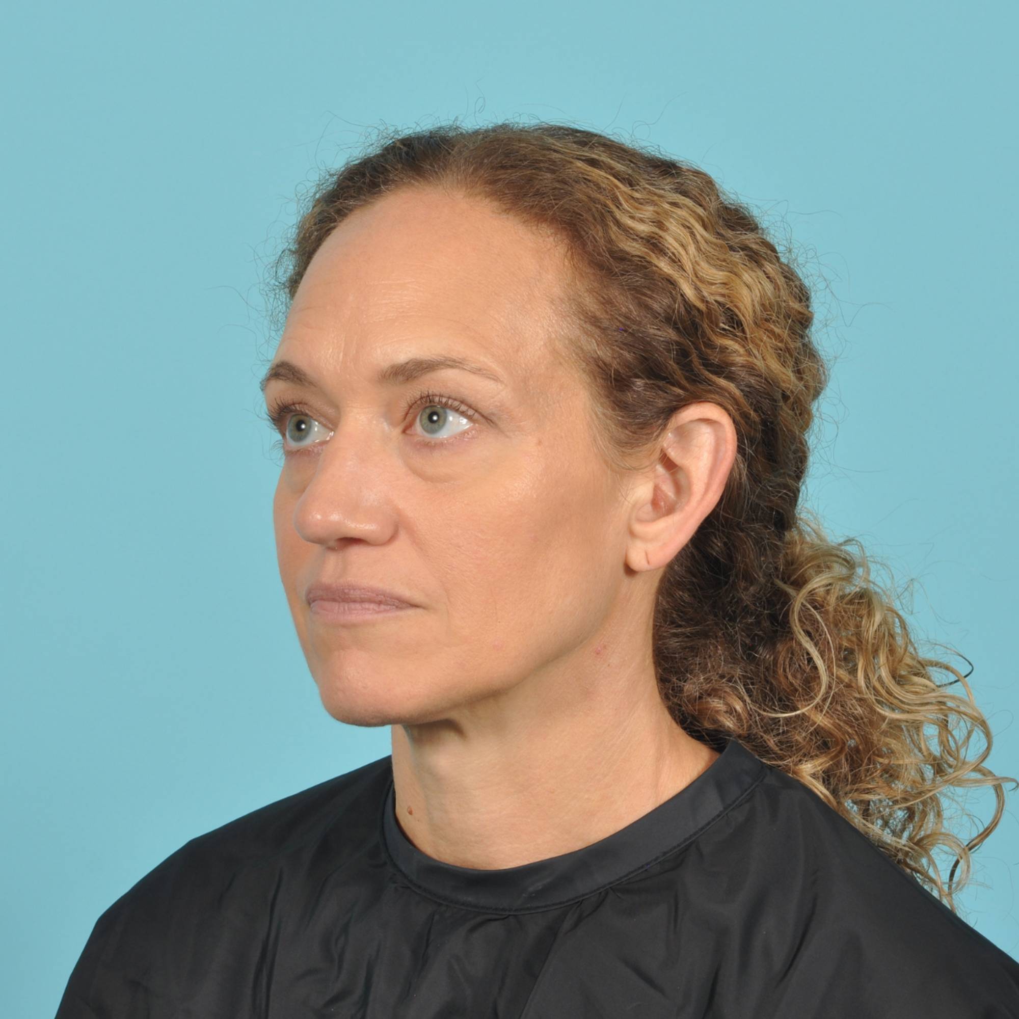 Blepharoplasty Before & After Image