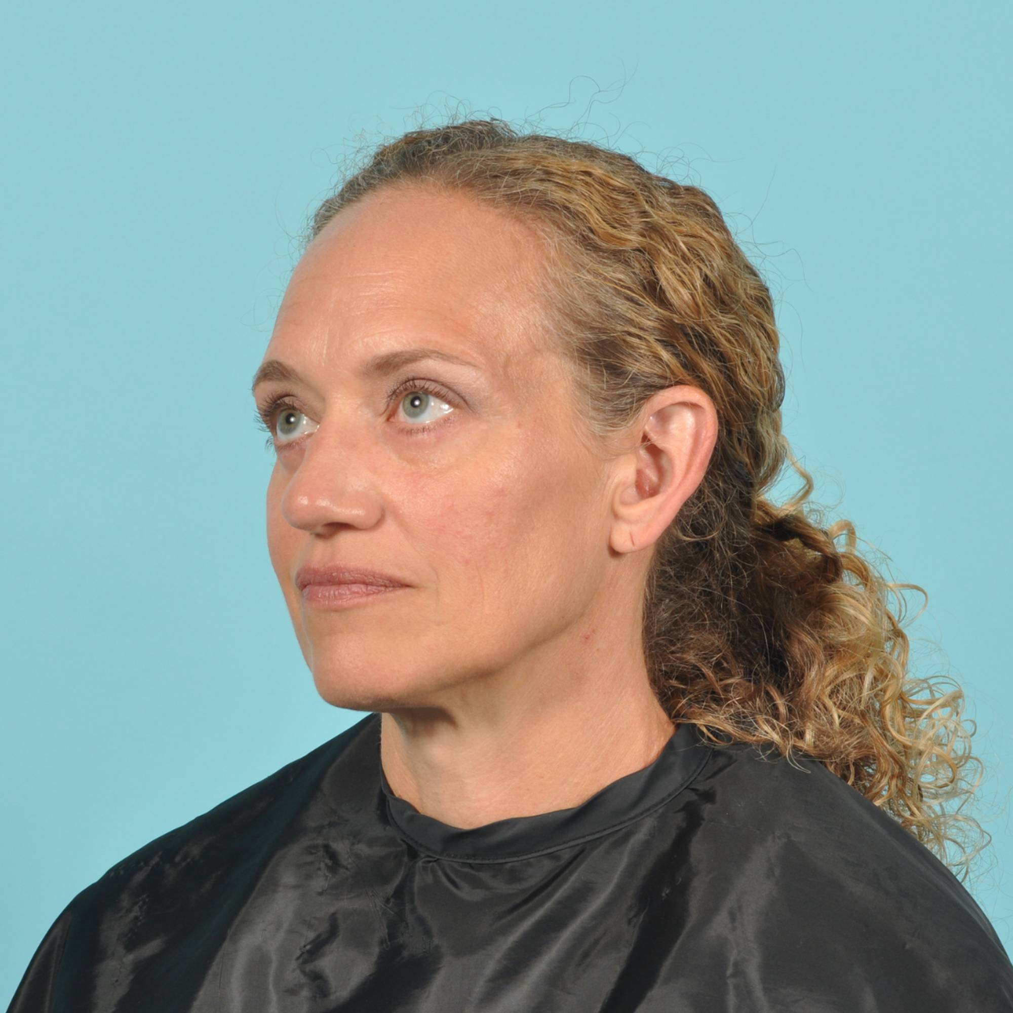 Blepharoplasty Before & After Image