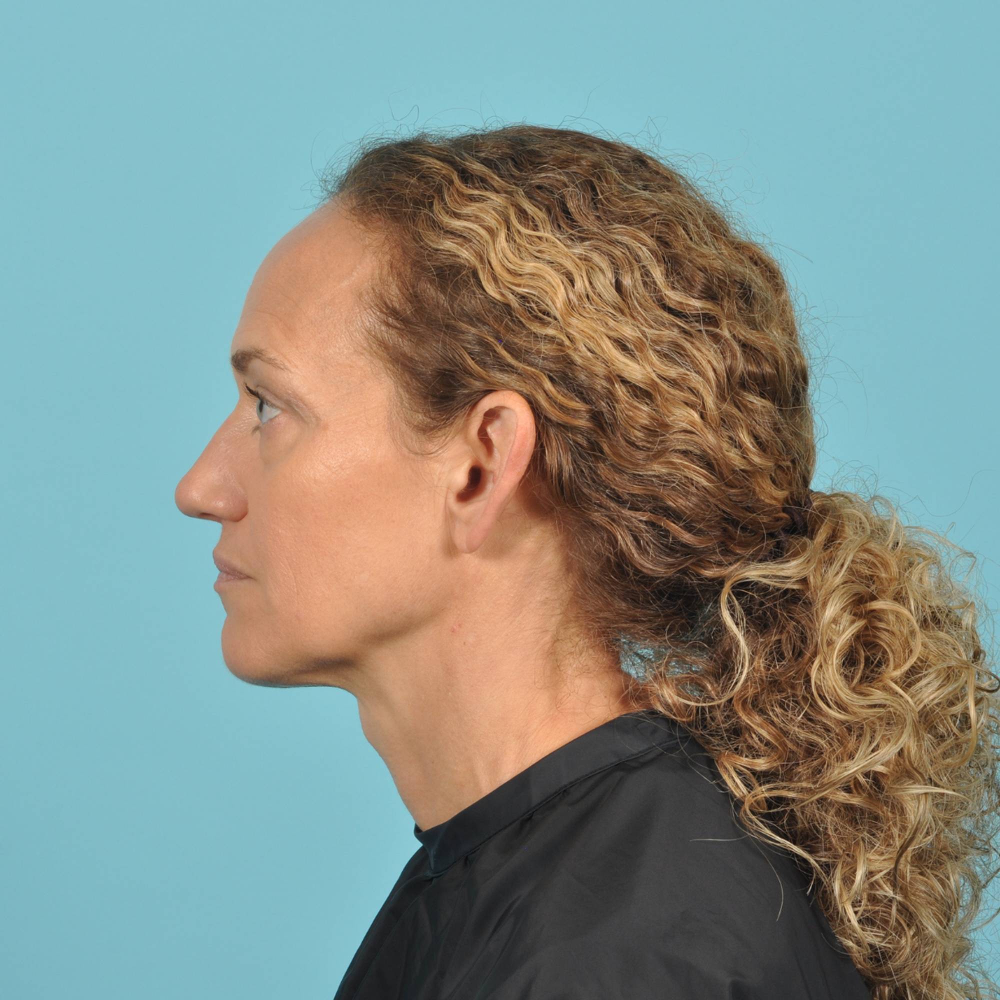 Blepharoplasty Before & After Image