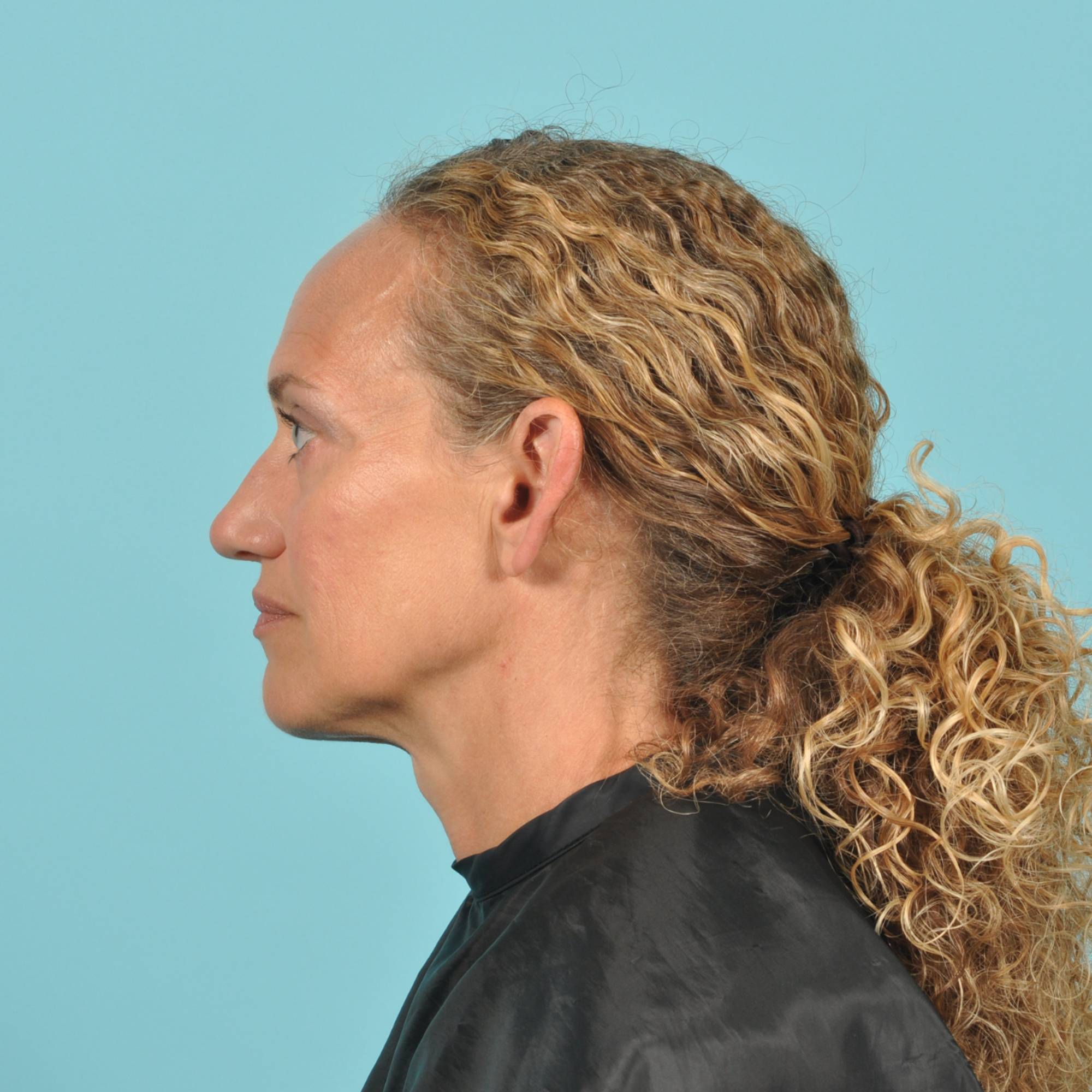 Blepharoplasty Before & After Image